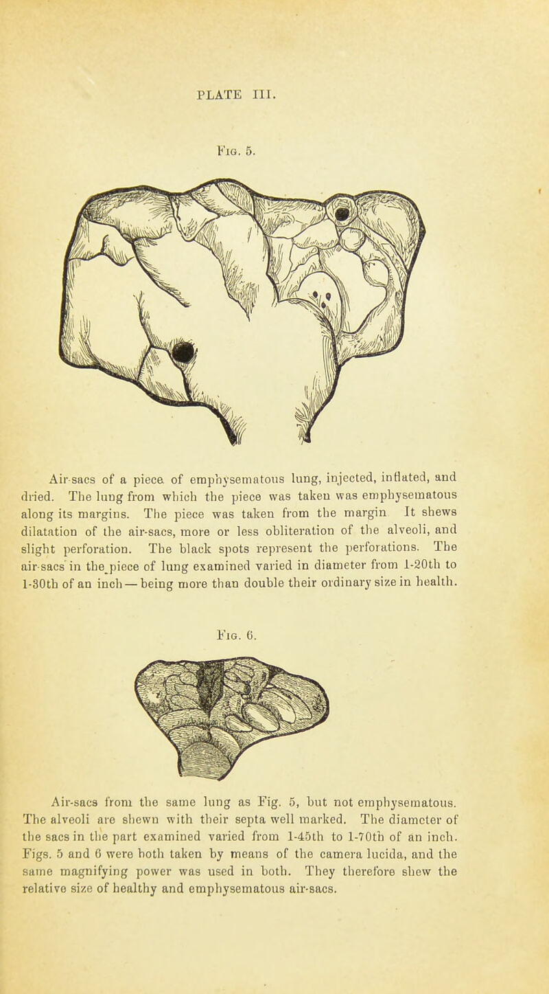 Fig. 5. Air sacs of a piece of emphysematous lung, injected, inflated, and dried. The lung from which the piece was taken was emphysematous along its margins. The piece was taken from the margin It shews dilatation of the air-sacs, more or less obliteration of the alveoli, and slight perforation. The black spots represent the perforations. The air sacs in the piece of lung examined varied in diameter from l-20th to l-30th of an inch —being more than double their ordinary size in health. Fig. 0. Air-sacs from the same lung as Fig. 5, but not emphysematous. The alveoli are shewn with their septa well marked. The diameter of the sacs in the part examined varied from l-45th to l-70tb of an inch. Figs. 5 and 6 were both taken by means of the camera lucida, and the same magnifying power was used in both. They therefore shew the relative size of healthy and emphysematous air-sacs.