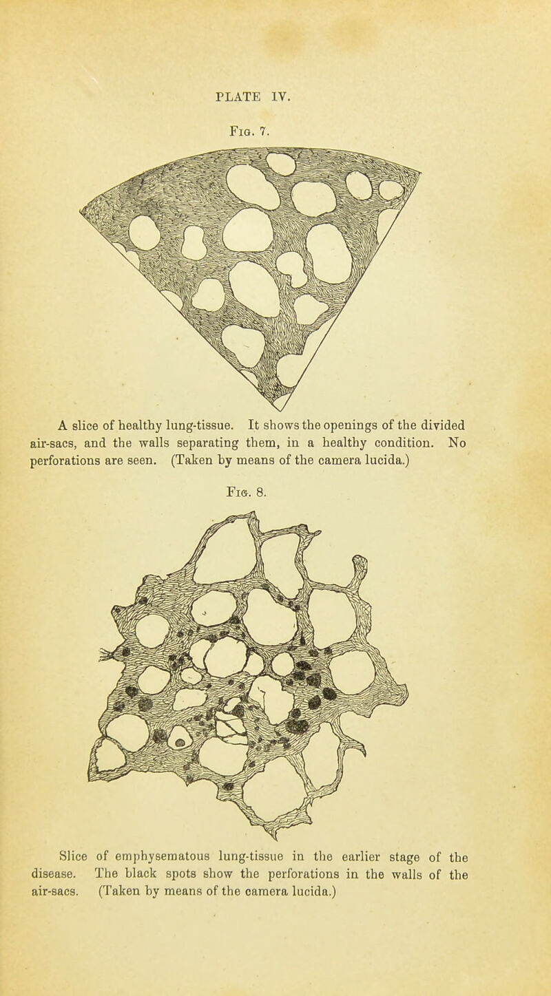 Fig. 7. A slice of healthy lung-tissue. It shows the openings of the divided air-sacs, and the walls separating them, in a healthy condition. No pei'forations are seen. (Taken by means of the camera lucida.) Fis. 8. Slice of emphysematous lung-tissue in the earlier stage of the disease. The black spots show the perforations in the walls of the air-sacs. (Taken by means of the camera lucida.)