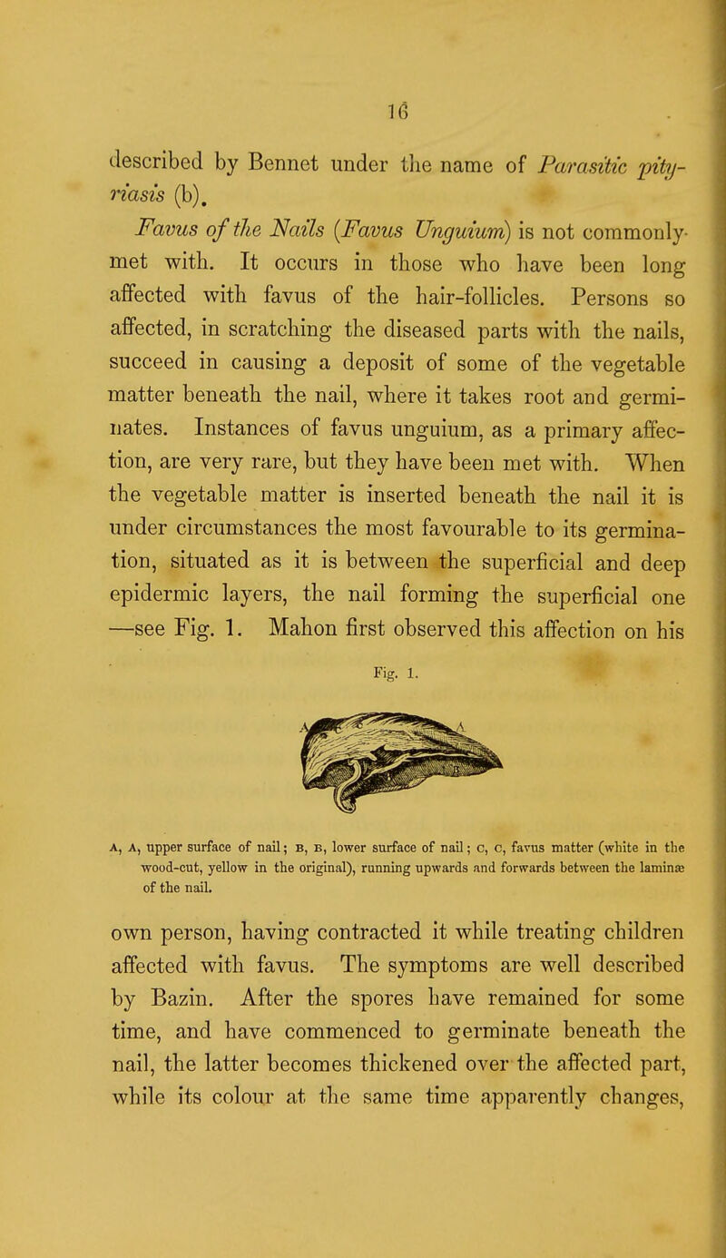described by Bennet under the name of Parasitic pity- riasis (b). Favus of the Nails (Favus Unguium) is not commonly- met with. It occurs in those who have been long affected with favus of the hair-follicles. Persons so affected, in scratching the diseased parts with the nails, succeed in causing a deposit of some of the vegetable matter beneath the nail, where it takes root and germi- nates. Instances of favus unguium, as a primary affec- tion, are very rare, but they have been met with. When the vegetable matter is inserted beneath the nail it is under circumstances the most favourable to its germina- tion, situated as it is between the superficial and deep epidermic layers, the nail forming the superficial one —see Fig. 1. Mahon first observed this affection on his Fig. 1. A, A, tipper surface of nail; b, b, lower surface of nail; c, c, favus matter (white in the wood-cut, yellow in the original), running upwards and forwards between the lamina? of the nail. own person, having contracted it while treating children affected with favus. The symptoms are well described by Bazin. After the spores have remained for some time, and have commenced to germinate beneath the nail, the latter becomes thickened over the affected part, while its colour at the same time apparently changes,