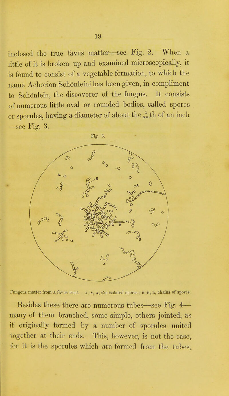 inclosed the true favus matter—see Fig. 2. When a little of it is broken up and examined microscopically, it is found to consist of a vegetable formation, to which the name Achorion Schonleini has been given, in compliment to Schonlein, the discoverer of the fungus. It consists of numerous little oval or rounded bodies, called spores or sporules, having a diameter of about the ,^0th of an inch —see Fig. 3. Fig. 3. Fungous matter from a favus crust. A, A, A, the isolated' spores; B-, u, b, chains of spores. Besides these there are numerous tubes—see Fig. 4— many of them branched, some simple, others jointed, as if originally formed by a number of sporules united together at their ends. This, however, is not the case, for it is the sporules which are formed from the tubes,