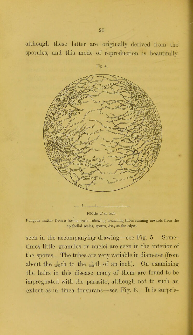 although these latter are originally derived from the spondee, and this mode of reproduction is beautifully Fig. 4. ! I J _l lOOOths of an inch. Fungous matter from a favous crust—showing branching tubes running inwards from the epithelial scales, spores, &c, at the edges. seen in the accompanying drawing—see Fig. 5. Some- times little granules or nuclei are seen in the interior of the spores. The tubes are very variable in diameter (from about the ~th to the ^th of an inch). On examining the hairs in this disease many of them are found to be impregnated with the parasite, although not to such an extent as in tinea tonsurans—see Fig. 6. It is surpris-