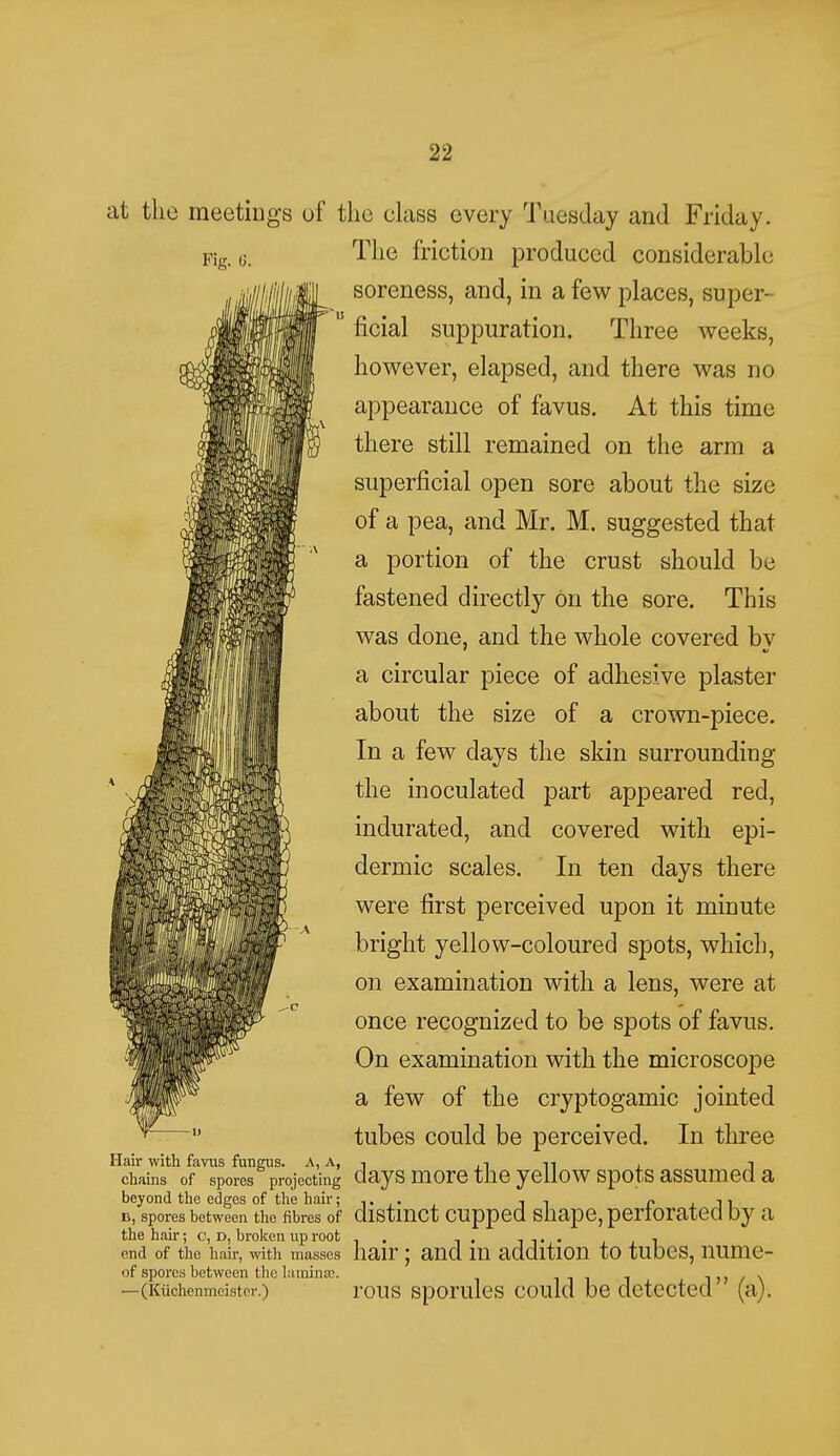 at the meetings of the class every Tuesday and Friday. The friction produced considerable soreness, and, in a few places, super- ficial suppuration. Three weeks, however, elapsed, and there was no appearance of favus. At this time there still remained on the arm a superficial open sore about the size of a pea, and Mr. M. suggested that a portion of the crust should be fastened directly on the sore. This was done, and the whole covered bv a circular piece of adhesive plaster about the size of a crown-piece. In a few days the skin surrounding the inoculated part appeared red, indurated, and covered with epi- dermic scales. In ten days there were first perceived upon it minute bright yellow-coloured spots, which, on examination with a lens, were at once recognized to be spots of favus. On examination with the microscope a few of the cryptogamic jointed tubes could be perceived. In three Hair with favus fungus. A, A, .-, . n chains of spores projecting days more the yellow spots assumed a beyond the edges of the hair; ,. . , , c ■,■> d, spores between the fibres of distinct cupped shape, perforated by a the hair; c, d, broken up root . , . . .., , . end of the hair, with masses hair J and 111 addition to tllDCS, 11111110- <>f spores between the lamina?. -n; / \ —(Kiichenmcistcr.) rous sporules could be detected (a).
