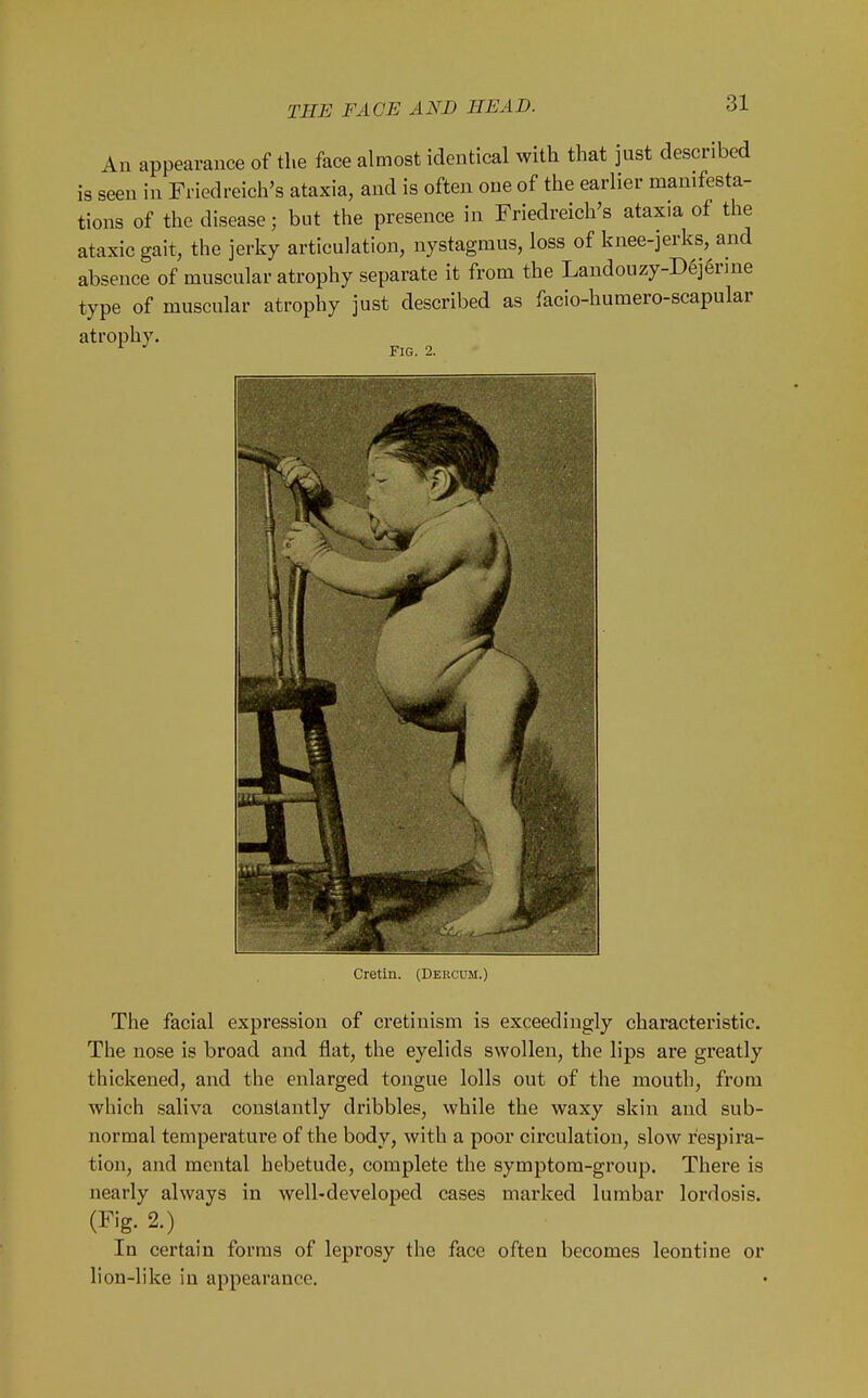 An appearance of the face almost identical with that just described is seen in Friedreich's ataxia, and is often one of the earlier manifesta- tions of the disease; but the presence in Friedreich's ataxia of the ataxic gait, the jerky articulation, nystagmus, loss of knee-jerks, and absence of muscular atrophy separate it from the Landouzy-Dej^rine type of muscular atrophy just described as facio-humero-scapular atrophy. Fig. 2. Cretin. (Dercdm.) The facial expression of cretinism is exceedingly characteristic. The nose is broad and flat, the eyelids swollen, the lips are greatly thickened, and the enlarged tongue lolls out of the mouth, from which saliva constantly dribbles, while the waxy skin and sub- normal temperature of the body, with a poor circulation, slow respira- tion, and mental hebetude, complete the symptom-group. There is nearly always in well-developed cases marked lumbar lordosis. (Fig. 2.) In certain forms of leprosy the face often becomes leontine or lion-like in appearance.