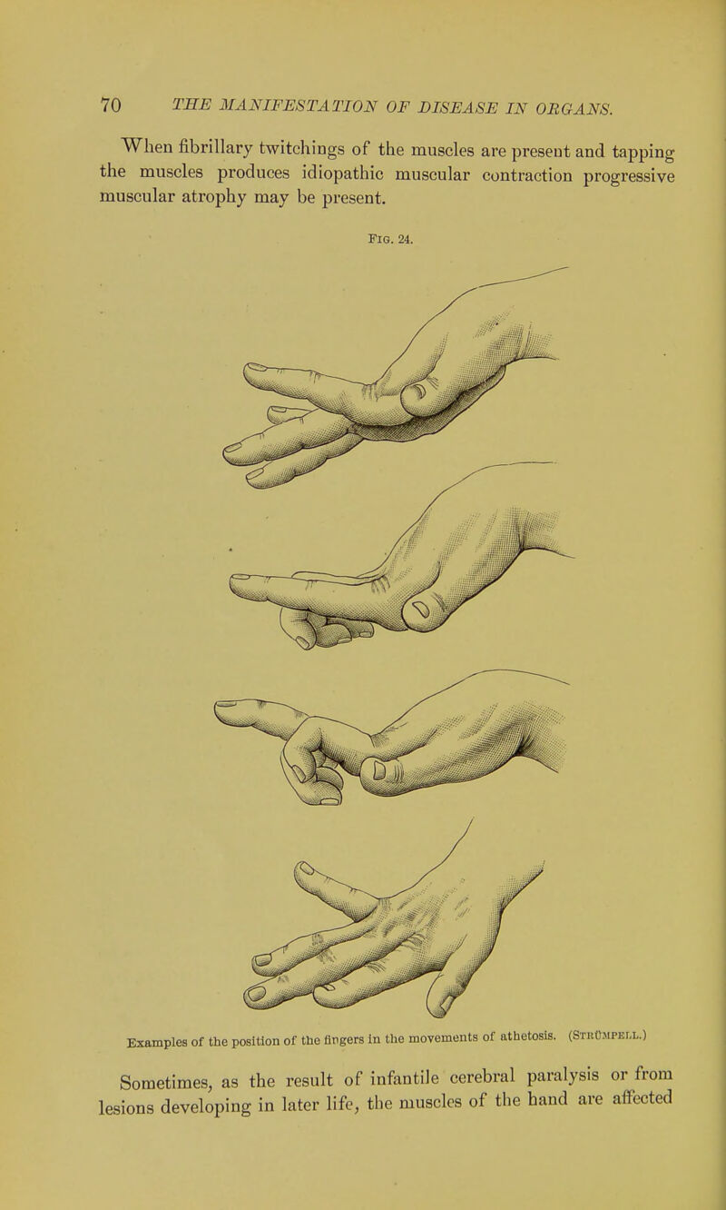 When fibrillary twitchings of the muscles are present and tapping the muscles produces idiopathic muscular contraction progressive muscular atrophy may be present. Fig. 24. Examples of the position of the fingers in the movements of athetosis. (StuOmpell.) Sometimes, as the result of infantile cerebral paralysis or from lesions developing in later life, the muscles of the hand are affected