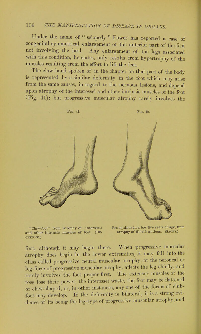 Under the name of sciopedy  Power has reported a case of congenital symmetrical enlargement of the anterior part of the foot not involving the heel. Any enlargement of the legs associated with this condition, he states, only results from hypertrophy of the muscles resulting from the effort to lift the feet. The claw-hand spoken of in the chapter on that part of the body is represented by a similar deformity in the foot which may arise from the same causes, in regard to the nervous lesions, and depend upon atrophy of the interossei and other intrinsic muscles of the foot (Fig. 41); but progressive muscular atrophy rarely involves the  Claw-foot from atrophy of interossei Pes equinus in a boy five years of age, trom and other intrinsic muscles of foot. (Du- atrophy of tibialis anticus. (Sachs.) CHENNK.) foot, although it may begin there. When progressive muscular atrophy does begin in the lower extremities, it may fall into the class called progressive neural muscular atrophy, or the peroneal or leg-form of progressive muscular atrophy, affects the leg chiefly, aud rarely involves°the foot proper first. The extensor muscles of the toes lose their power, the interossei waste, the foot may be flattened or claw-shaped, or, in other instances, any one of the forms of club- foot may develop. If the deformity is bilateral, it is a strong evi- dence of its being the leg-type of progressive muscular atrophy, and