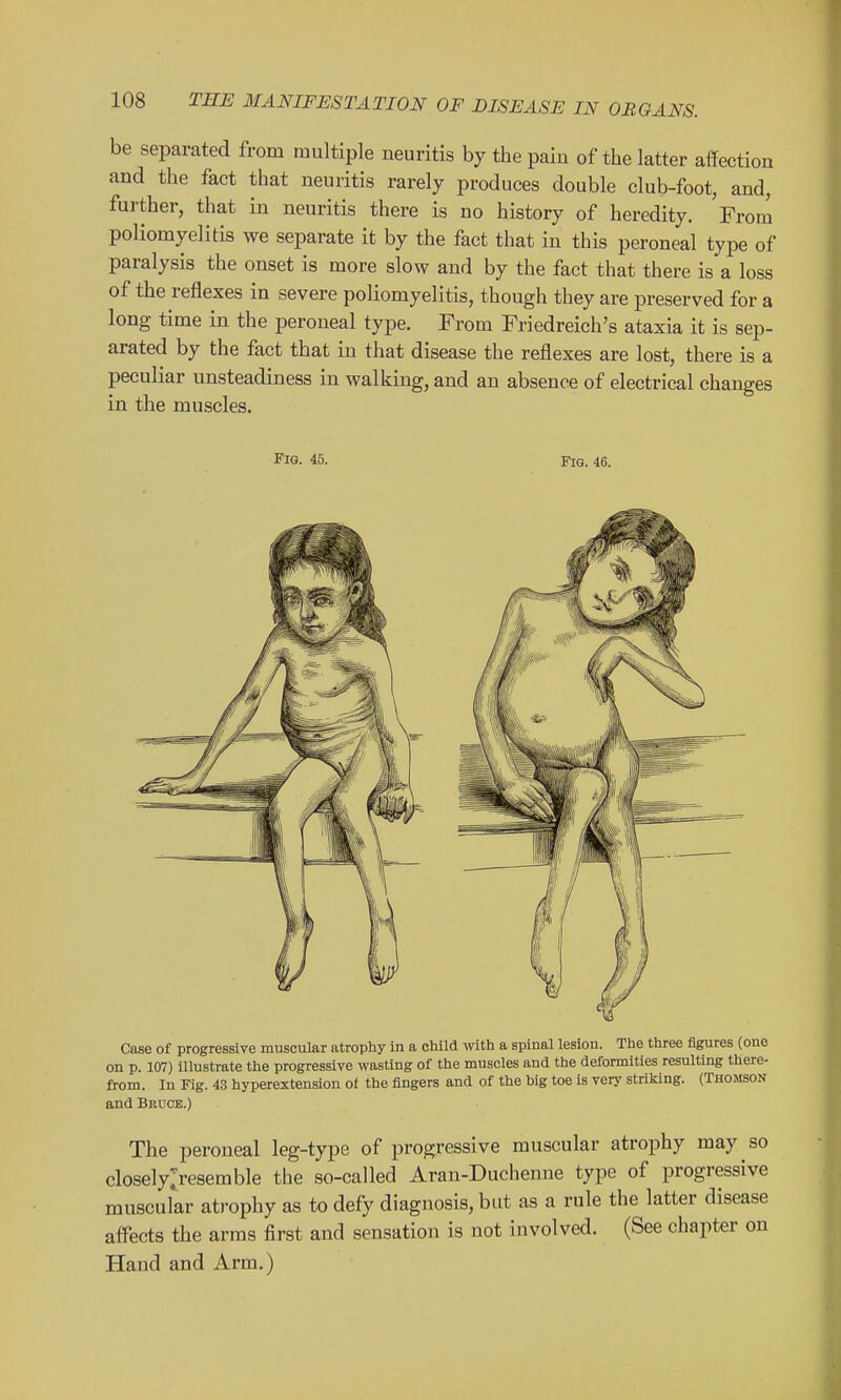 be separated from multiple neuritis by the pain of the latter affection and the fact that neuritis rarely produces double club-foot, and, further, that in neuritis there is no history of heredity. From poliomyelitis we separate it by the fact that in this peroneal type of paralysis the onset is more slow and by the fact that there is a loss of the reflexes in severe poliomyelitis, though they are preserved for a long time in the peroneal type. From Friedreich's ataxia it is sep- arated by the fact that in that disease the reflexes are lost, there is a peculiar unsteadiness in walking, and an absence of electrical changes in the muscles. Fig. 45. Fig. 46. Case of progressive muscular atrophy in a child with a spinal lesion. The three figures (one on p. 107) illustrate the progressive wasting of the muscles and the deformities resulting there- from. In Fig. 43 hyperextension of the fingers and of the big toe is very striking. (Thomson and Bkuce.) The peroneal leg-type of progressive muscular atrophy may so closelyjresemble the so-called Aran-Duchenne type of progressive muscular atrophy as to defy diagnosis, but as a rule the latter disease affects the arms first and sensation is not involved. (See chapter on Hand and Arm.)