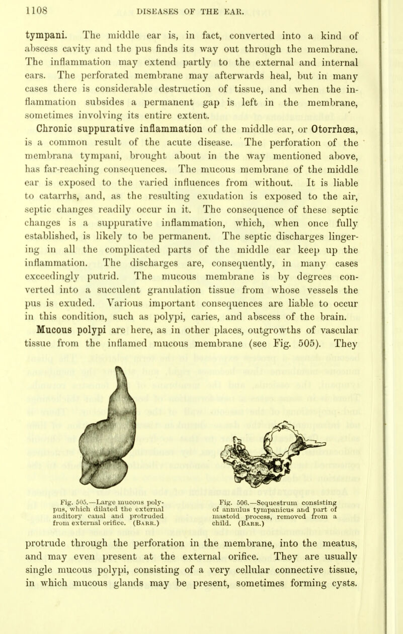 tympani. The middle ear is, in fact, converted into a kind of abscess cavity and the pus finds its way out through the membrane. The inflammation may extend partly to the external and internal ears. The perforated membrane may afterwards heal, but in many cases there is considerable destruction of tissue, and when the in- flammation subsides a permanent gap is left in the membrane, sometimes involving its entire extent. Chronic suppurative inflammation of the middle ear, or Otorrhoea, is a common result of the acute disease. The perforation of the membrana tympani, brought about in the way mentioned above, has far-reaching consequences. The mucous membrane of the middle ear is exposed to the varied influences from without. It is liable to catarrhs, and, as the resulting exudation is exposed to the air, .septic changes readily occur in it. The consequence of these septic changes is a suppurative inflammation, which, when once fully established, is likely to be permanent. The septic discharges linger- in- in all the complicated parts of the middle ear keep up the inflammation. The discharges are, consequently, in many cases exceedingly putrid. The mucous membrane is by degrees con- verted into a succulent granulation tissue from whose vessels the pus is exuded. Various important consequences are liable to occur in this condition, such as polypi, caries, and abscess of the brain. Mucous polypi are here, as in other places, outgrowths of vascular tissue from the inflamed mucous membrane (see Fig. 505). They Fig. 505.—Large mucous poly- pus, which dilated the external auditory canal and protruded from external orifice. (Barr.) Fig. 506.—Sequestrum consisting of annulus tympanicus and part of mastoid process, removed from a child. (Barr.) protrude through the perforation in the membrane, into the meatus, and may even present at the external orifice. They are usually single mucous polypi, consisting of a very cellular connective tissue, in which mucous glands may be present, sometimes forming cysts.
