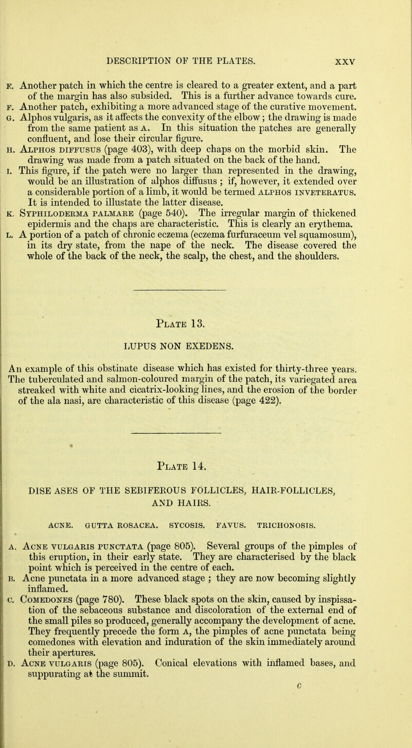 e. Another patch in which the centre is cleared to a greater extent, and a part of the margin has also subsided. This is a further advance towards cure. f. Another patch, exhibiting a more advanced stage of the curative movement. g. Alphos vulgaris, as it affects the convexity of the elbow; the drawing is made from the same patient as a. In this situation the patches are generally confluent, and lose their circular figure. h. Alphos diffusus (page 403), with deep chaps on the morbid skin. The drawing was made from a patch situated on the back of the hand. i. This figure, if the patch were no larger than represented in the drawing, would be an illustration of alphos diffusus ; if, however, it extended over a considerable portion of a limb, it would be termed alphos inveteratus. It is intended to illustate the latter disease. k. Syphiloderma palmare (page 540). The irregular margin of thickened epidermis and the chaps are characteristic. This is clearly an erythema. l. A portion of a patch of chronic eczema (eczema furfuraceum vel squamosum), in its dry state, from the nape of the neck. The disease covered the whole of the back of the neck, the scalp, the chest, and the shoulders. Plate 13. LUPUS NON EXEDENS. An example of this obstinate disease which has existed for thirty-three years. The tuberculated and salmon-coloured margin of the patch, its variegated area streaked with white and cicatrix-looking lines, and the erosion of the border of the ala nasi, are characteristic of this disease (page 422). Plate 14. DISE ASES OF THE SEBIFEROUS FOLLICLES, HAIR-FOLLICLES, AND HAIRS. ACNE. GUTTA ROSACEA. SYCOSIS. FAVUS. TRICHONOSTS. A. Acne vulgaris punctata (page 805). Several groups of the pimples of this eruption, in their early state. They are characterised by the black point which is perceived in the centre of each. b. Acne punctata in a more advanced stage ; they are now becoming slightly inflamed. c. Comedones (page 780). These black spots on the skin, caused by inspissa- tion of the sebaceous substance and discoloration of the external end of the small piles so produced, generally accompany the development of acne. They frequently precede the form A, the pimples of acne punctata being comedones with elevation and induration of the skin immediately around their apertures. d. Acne vulgaris (page 805). Conical elevations with inflamed bases, and suppurating at the summit. C