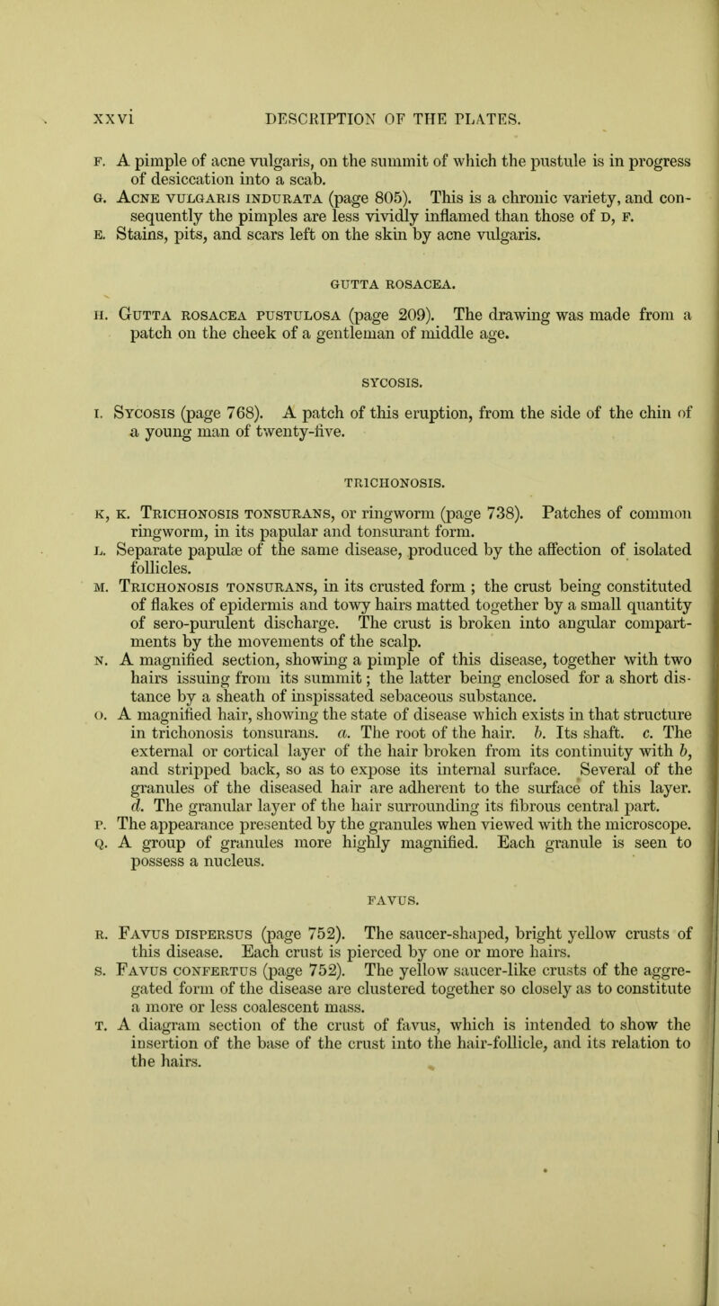 f. A pimple of acne vulgaris, on the summit of which the pustule is in progress of desiccation into a scab. G. Acne vulgaris indurata (page 805). This is a chronic variety, and con- sequently the pimples are less vividly inflamed than those of d, f. b. Stains, pits, and scars left on the skin by acne vulgaris. GUTTA ROSACEA. n. Gutta rosacea pustulosa (page 209). The drawing was made from a patch on the cheek of a gentleman of middle age. SYCOSIS. i. Sycosis (page 768). A patch of this eruption, from the side of the chin of a young man of twenty-five. TRICHONOSIS. k. Trichonosis tonsurans, or ringworm (page 738). Patches of common ringworm, in its papular and tonsurant form. Separate papulse of the same disease, produced by the affection of isolated follicles. Trichonosis tonsurans, in its crusted form ; the crust being constituted of flakes of epidermis and towy hairs matted together by a small quantity of sero-purulent discharge. The crust is broken into angular compart- ments by the movements of the scalp. A magnified section, showing a pimple of this disease, together with two hairs issuing from its summit; the latter being enclosed for a short dis- tance by a sheath of inspissated sebaceous substance. A magnified hair, showing the state of disease which exists in that structure in trichonosis tonsurans, a. The root of the hair. b. Its shaft, c. The external or cortical layer of the hair broken from its continuity with b, and stripped back, so as to expose its internal surface. Several of the granules of the diseased hair are adherent to the surface of this layer. d. The granular layer of the hair surrounding its fibrous central part. The appearance presented by the granules when viewed with the microscope. A group of granules more highly magnified. Each granule is seen to possess a nucleus. FAVUS. r. Favus dispersus (page 752). The saucer-shaped, bright yellow crusts of this disease. Each crust is pierced by one or more hairs. s. Favus confertus (page 752). The yellow saucer-like crusts of the aggre- gated form of the disease are clustered together so closely as to constitute a more or less coalescent mass. t. A diagram section of the crust of favus, which is intended to show the insertion of the base of the crust into the hair-follicle, and its relation to the hairs.