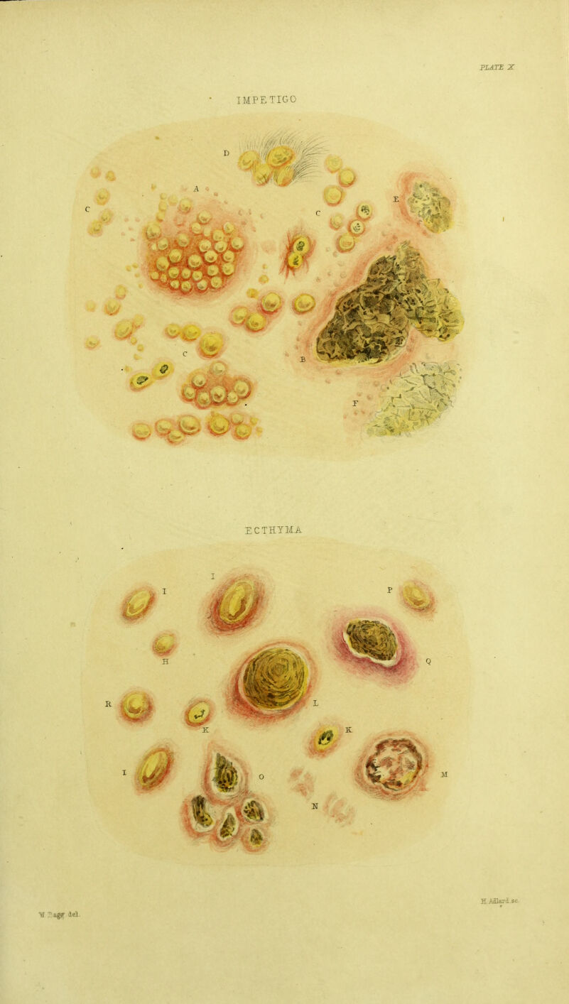 PLATE X IMPETIGO 3 A33ard.sc