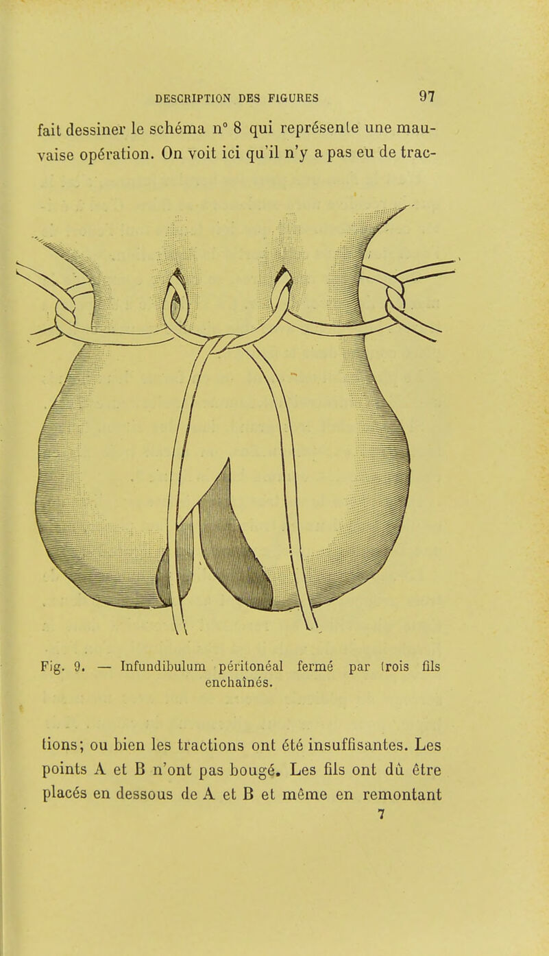 fait dessiner le schéma n° 8 qui représente une mau- vaise opération. On voit ici qu'il n'y a pas eu de trac- tions; ou bien les tractions ont été insuffisantes. Les points A et B n'ont pas bougé. Les fils ont dû être placés en dessous de A et B et même en remontant 7