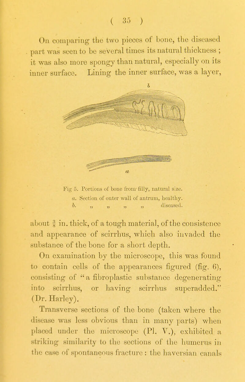 On comparing the two pieces of bone, the diseased part was seen to be several times its natural thickness ; it was also more spongy than natural, especially on its inner surface. Lining the inner surface, was a layer. Fig 5. Portious ol' bone I'roin- filly, natural size. a. Section of onter wall of antrum, healthy. b. „ „ „ „ diseased. about fin. thick, of a tough material, of the consistence and appearance of scirrhus, which also invaded the substance of the bone for a short depth. On examination by the microscope, this was found to contain cells of the appearances figured (fig. 6), consisting of a fibroplastic substance degenerating into sciri'hus, or having scirrhus superadded. (Dr. Harley). Transverse sections of the bone (taken where the disease was less obvious than in many parts) Mdien {>laced under the microscope (PI. V.), exhibited a striking similarity to the sections of the humerus in the case of spontaneous fracture : the haversian canals