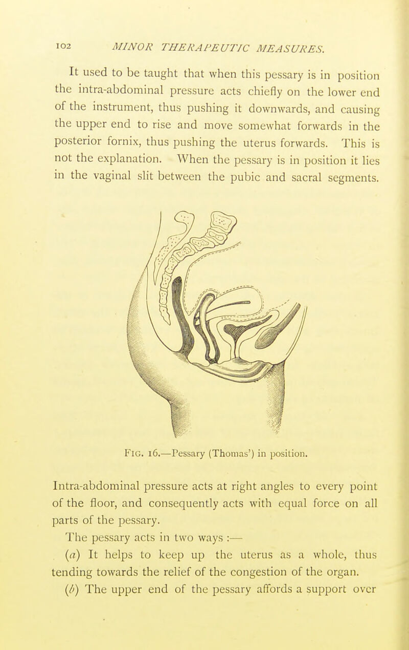 It used to be taught that when this pessary is in position the intra-abdominal pressure acts chiefly on the lower end of the instrument, thus pushing it downwards, and causing the upper end to rise and move somewhat forwards in the posterior fornix, thus pushing the uterus forwards. This is not the explanation. When the pessary is in position it lies in the vaginal slit between the pubic and sacral segments. Fig. 16.—Pessary (Thomas') in position. Intra-abdominal pressure acts at right angles to every point of the floor, and consequently acts with equal force on all parts of the pessary. The pessary acts in two ways :— (a) It helps to keep up the uterus as a whole, thus tending towards the relief of the congestion of the organ. (/;) The upper end of the pessary affords a support over
