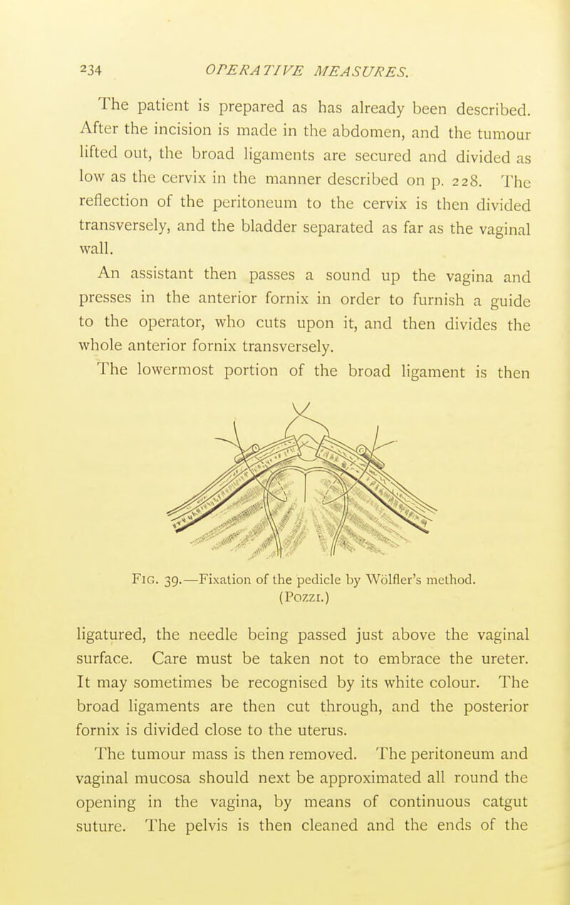 The patient is prepared as has already been described. After the incision is made in the abdomen, and the tumour lifted out, the broad ligaments are secured and divided as low as the cervix in the manner described on p. 228. The reflection of the peritoneum to the cervix is then divided transversely, and the bladder separated as far as the vaginal wall. An assistant then passes a sound up the vagina and presses in the anterior fornix in order to furnish a guide to the operator, who cuts upon it, and then divides the whole anterior fornix transversely. The lowermost portion of the broad ligament is then FlG. 39.—Fixation of the pedicle by Wolfler's method. (Pozzi.) ligatured, the needle being passed just above the vaginal surface. Care must be taken not to embrace the ureter. It may sometimes be recognised by its white colour. The broad ligaments are then cut through, and the posterior fornix is divided close to the uterus. The tumour mass is then removed. The peritoneum and vaginal mucosa should next be approximated all round the opening in the vagina, by means of continuous catgut suture. The pelvis is then cleaned and the ends of the