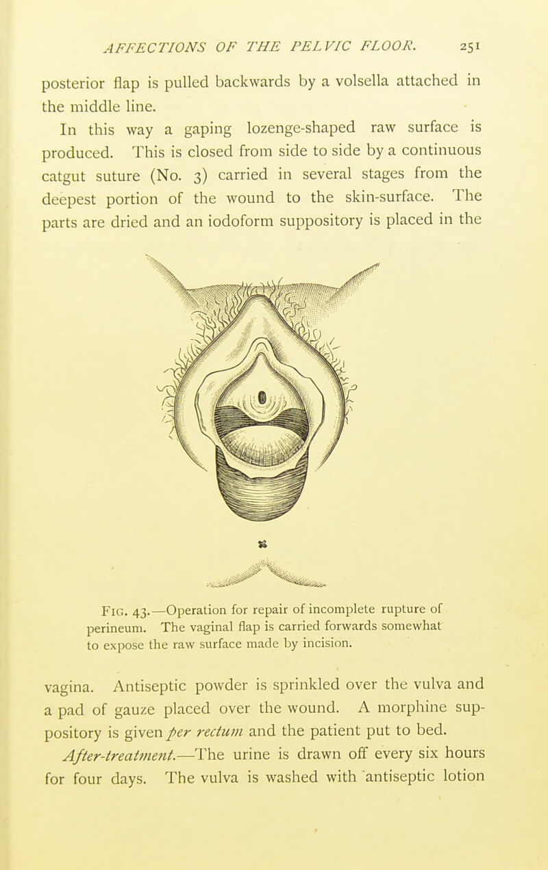 posterior flap is pulled backwards by a volsella attached in the middle line. In this way a gaping lozenge-shaped raw surface is produced. This is closed from side to side by a continuous catgut suture (No. 3) carried in several stages from the deepest portion of the wound to the skin-surface. The parts are dried and an iodoform suppository is placed in the Fig. 43.—Operation for repair of incomplete rupture of perineum. The vaginal flap is carried forwards somewhat to expose the raw surface made by incision. vagina. Antiseptic powder is sprinkled over the vulva and a pad of gauze placed over the wound. A morphine sup- pository is given per rectum and the patient put to bed. After-treatment.—The urine is drawn off every six hours for four days. The vulva is washed with antiseptic lotion