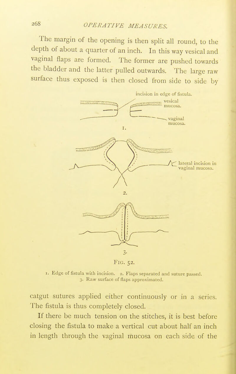 The margin of the opening is then split all round, to the depth of about a quarter of an inch. In this way vesical and vaginal flaps are formed. The former are pushed towards the bladder and the latter pulled outwards. The large raw surface thus exposed is then closed from side to side by incision in edge of fistula. vesical mucosa. Jxl lateral incision in vaginal mucosa. 5- Fig. 52. 1. Edge of fistula with incision. 2. Flaps separated and suture passed. 3. Raw surface of flaps approximated. catgut sutures applied either continuously or in a series. The fistula is thus completely closed. If there be much tension on the stitches, it is best before closing the fistula to make a vertical cut about half an inch in length through the vaginal mucosa on each side of the