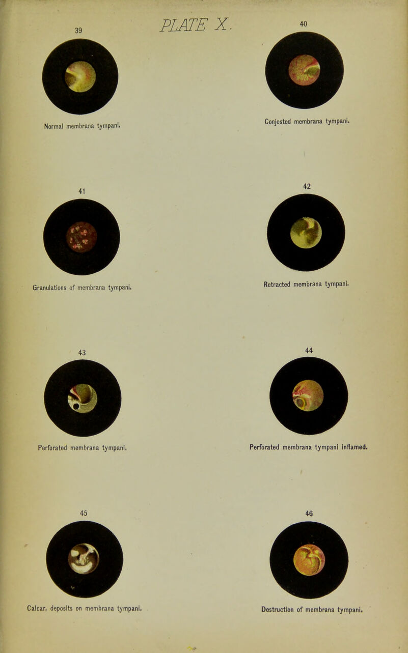 „ , , . , Coniested membrana tympani. Normal membrana tympani. 41 Granulations of membrana tympani. 43 Perforated membrana tympani. 42 Retracted membrana tympani. 44 Perforated membrana tympani Inflamed.