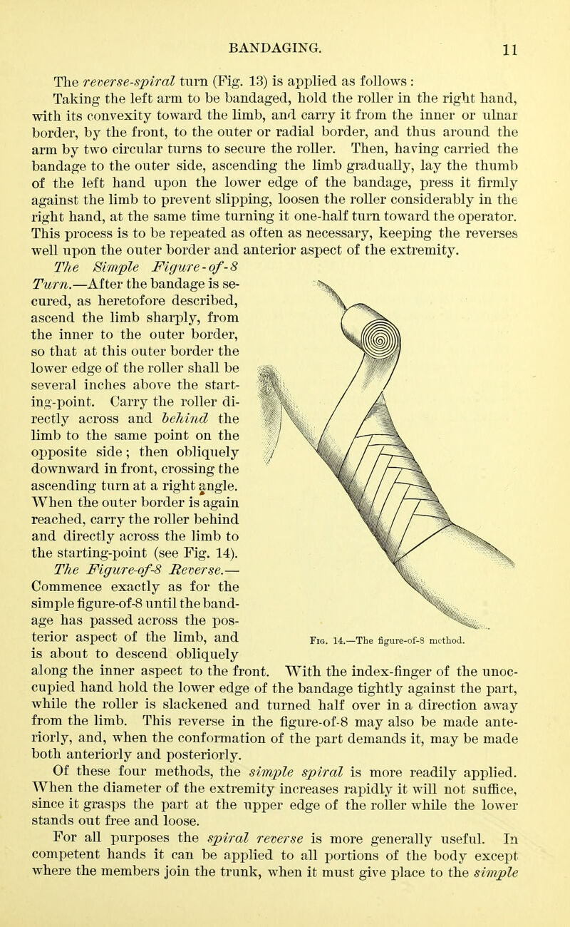 The remrse-spiral turn (Fig. 13) is applied as follows : Taking the left arm to be bandaged, hold the roller in the right hand, with its convexity toward the limb, and carry it from the inner or ulnar border, by the front, to the outer or radial border, and thus around the arm by two circular turns to secure the roller. Then, having carried the bandage to the outer side, ascending the limb gradually, lay the thumb of the left hand upon the lower edge of the bandage, press it firmly against the limb to prevent slipping, loosen the roller considerably in the right hand, at the same time turning it one-half turn toward the operator. This process is to be repeated as often as necessary, keeping the reverses well upon the outer border and anterior aspect of the extremity. The Simple Figure - of- 8 Turn.—After the bandage is se- cured, as heretofore described, ascend the limb sharply, from the inner to the outer border, so that at this outer border the lower edge of the roller shall be several inches above the start- ing-point. Carry the roller di- rectly across and heJiind the limb to the same point on the opposite side; then obliquely downward in front, crossing the ascending turn at a right angle. When the outer border is again reached, carry the roller behind and directly across the limb to the starting-point (see Fig. 14). The Figure-of-8 Reverse.— Commence exactly as for the simple figure-of-8 until the band- age has passed across the pos- terior aspect of the limb, and is about to descend obliquely along the inner aspect to the front. With the index-finger of the unoc- cupied hand hold the lower edge of the bandage tightly against the part, while the roller is slackened and turned half over in a direction away from the limb. This reverse in the figure-of-8 may also be made ante- riorly, and, when the conformation of the part demands it, may be made both anteriorly and posteriorly. Of these four methods, the simple spiral is more readily applied. When the diameter of the extremity increases rapidly it will not suffice, since it grasps the part at the upper edge of the roller while the lower stands out free and loose. For all purposes the spiral reverse is more generally useful. In competent hands it can be applied to all portions of the body except where the members join the trunk, when it must give place to the simple Fio. 14.—The figure-of-8 method.