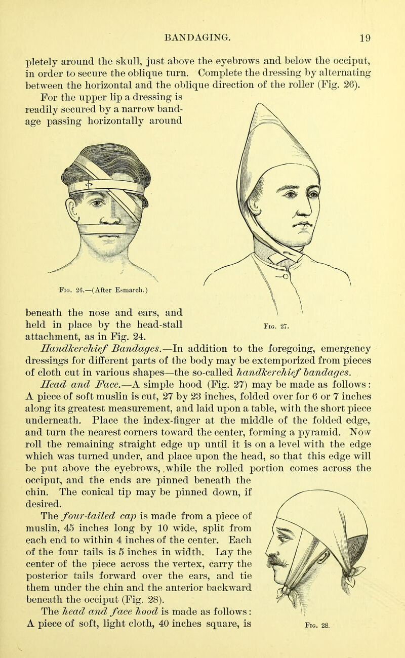 pletely around the skull, Just above the eyebrows and below the occiput, in order to secure the oblique turn. Complete the dressing by alternating between the horizontal and the oblique direction of the roller (Fig, 26). For the upper lip a dressing is held in place by the head-stall no. 27. attachment, as in Fig. 24. Handkerchief Bandages.—In addition to the foregoing, emergency dressings for different parts of the body may be extemporized from pieces of cloth cut in various shapes—the so-called handkerchief bandages. Head and Face.—A simple hood (Fig. 27) may be made as follows: A piece of soft muslin is cut, 27 by 23 inches, folded over for 6 or 7 inches along its greatest measurement, and laid upon a table, with the short piece underneath. Place the index-finger at the middle of the folded edge, and turn the nearest corners toward the center, forming a pyramid. No v roll the remaining straight edge up until it is on a level with the edge which was turned under, and place upon the head, so that this edge will be put above the eyebrows, .while the rolled portion comes across the occiput, and the ends are pinned beneath the chin. The conical tip may be pinned down, if desired, , \ The four-tailed cap is made from a piece of yC..^^ \\ \ muslin, 45 inches long by 10 wide, split from 1 each end to within 4 inches of the center. Each / of the four tails is 5 inches in width. Lay the L center of the piece across the vertex, carry the J posterior tails forward over the ears, and tie them under the chin and the anterior backward beneath the occiput (Fig. 28). The Jiead and face hood is made as follows: ' f A piece of soft, light cloth, 40 inches square, is Fw. 28. V