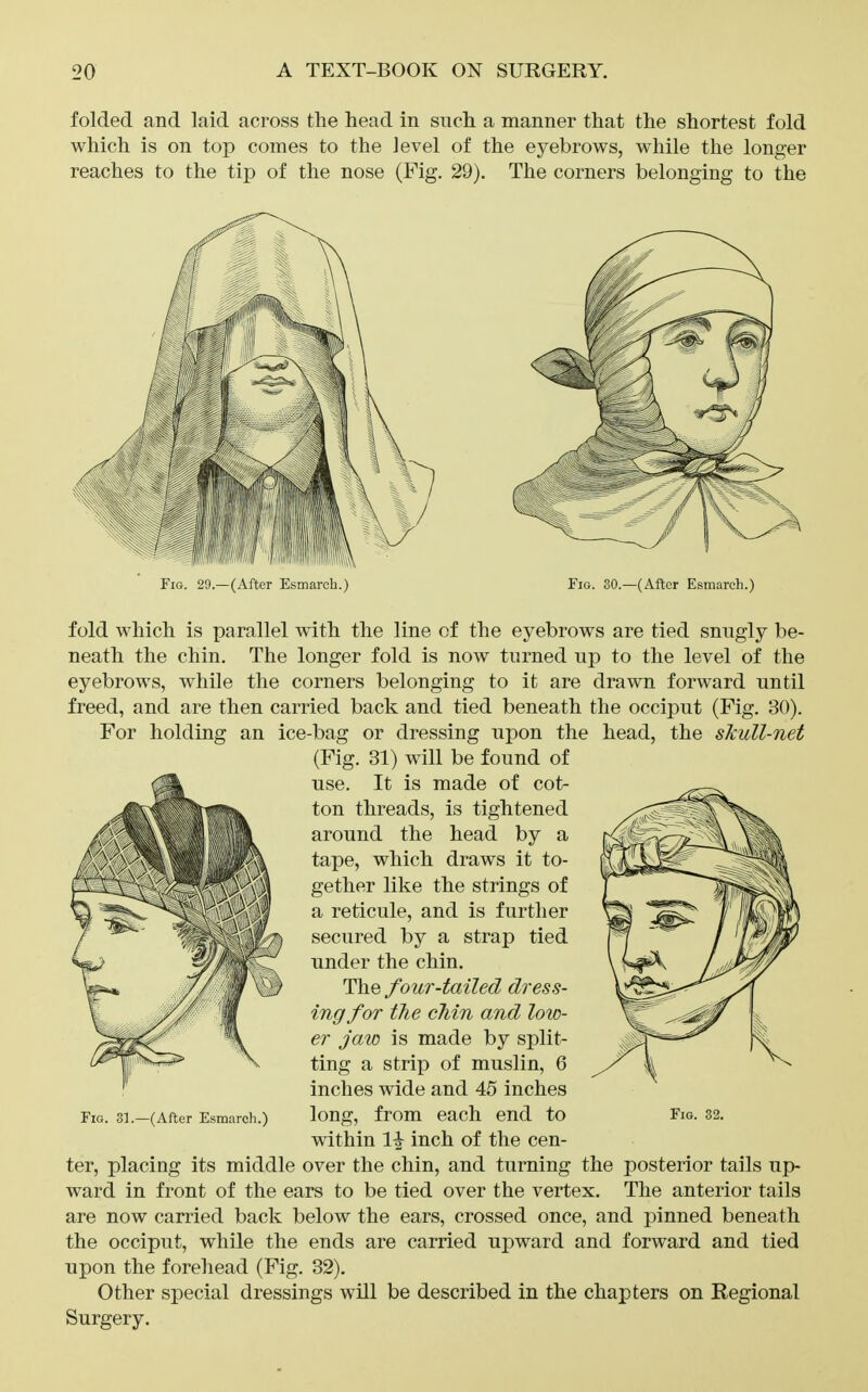 folded and laid across the head in sucli a manner that the shortest fold which is on top comes to the level of the eyebrows, while the longer reaches to the tip of the nose (Fig. 29). The corners belonging to the (After Esmarch.) Fig. 30.—(After Esmarch.) fold which is parallel with the line of the eyebrows are tied snngly be- neath the chin. The longer fold is now turned up to the level of the eyebrows, while the corners belonging to it are drawn forward until freed, and are then carried back and tied beneath the occiput (Fig. 30). For holding an ice-bag or dressing upon the head, the skull-net (Fig. 31) wall be found of use. It is made of cot- ton threads, is tightened around the head by a tape, which draws it to- gether like the strings of a reticule, and is further secured by a strap tied under the chin. The four-tailed dress- ing for the chin and low- er jaw is made by split- ting a strip of muslin, 6 inches wide and 45 inches within inch of the cen- ter, placing its middle over the chin, and turning the posterior tails up- ward in front of the ears to be tied over the vertex. The anterior tails are now carried back below the ears, crossed once, and pinned beneath the occiput, while the ends are carried upward and forward and tied upon the forehead (Fig. 32). Other special dressings will be described in the chapters on Regional Surgery. Fig. 31.—(After Esmarch.)