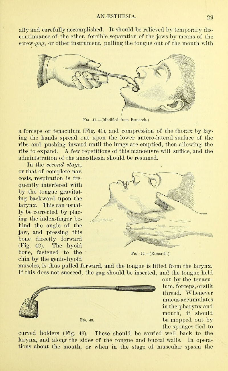 ally and carefully accoraplished. It should be relieved by temporary dis- continuance of the ether, forcible separation of the Jaws by means of the screw-gag, or other instrument, pulling the tongue out of the mouth with Fio. 41.—(Modified from Esuiarch.) a forceps or tenaculum (Fig. 41), and compression of the thorax by lay- ing the hands spread out upon the lower antero-lateral surface of the ribs and pushing inward until the lungs are emptied, then allowing the ribs to expand. A few repetitions of this manoeuvre will suffice, and the administration of the anaesthesia should be resumed. In the second stage, or that of complete nar- cosis, respiration is fre- quently interfered with by the tongue gravitat- ing backward upon the larynx. This can usual- ly be corrected by plac- ing the index-finger be- hind the angle of the jaw, and pressing this bone directly forward (Fig. 42). The hyoid bone, fastened to the chin by the genio-hyoid muscles, is thus pulled forward, and the tongue is lifted from the larynx. If this does not succeed, the gag should be inserted, and the tongue held out by the tenacu- lum, forceps, or silk thread. Whenever mucus accumulates in the pharynx and mouth, it should Fig. 43. be mopped out by the sponges tied to curved holders (Fig. 43). These should be carried well back to the larynx, and along the sides of the tongue and buccal walls. In opera- tions about the mouth, or when in the stage of muscular spasm the Fig. 42.—(Esmarch.)