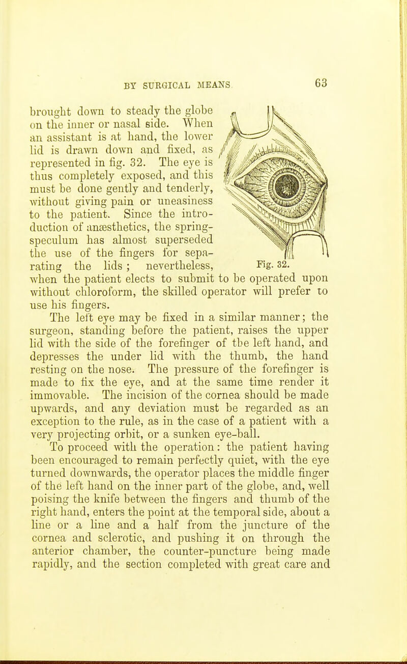 bi'oiight down to steady the globe on the inner or nasal side. When an assistant is at hand, the loAver lid is draAvn doAvn and fixed, as represented in fig. 32. The eye is thus completely exposed, and this must be done gently and tenderly, Avithout giving pain or uneasiness to the patient. Since the intro- duction of anaesthetics, the spring- speculum has almost superseded the use of the fingers for sepa- rating Fig. 32. the lids; nevertheless, Avhen the patient elects to submit to be operated upon Avithout chloroform, the skilled operator Avill prefer to use his fingers. The lelt eye may be fixed in a similar manner; the surgeon, standing before the patient, raises the upper lid with the side of the forefinger of the left hand, and depresses the under lid with the thumb, the hand resting on the nose. The pressure of the forefinger is made to fix the eye, and at the same time render it immovable. The incision of the cornea should be made upwards, and any deviation must be regarded as an exception to the rule, as in the case of a patient with a very projecting orbit, or a sunken eye-ball. To proceed with the operation: the patient having been encouraged to remain perfectly quiet, with the eye turned downwards, the operator places the middle finger of the left hand on the inner part of the globe, and, Avell poising the knife between the fingers and thumb of the right hand, enters the point at the temporal side, about a line or a line and a half from the juncture of the cornea and sclerotic, and pushing it on through the anterior chamber, the counter-puncture being made rapidly, and the section completed with great care and