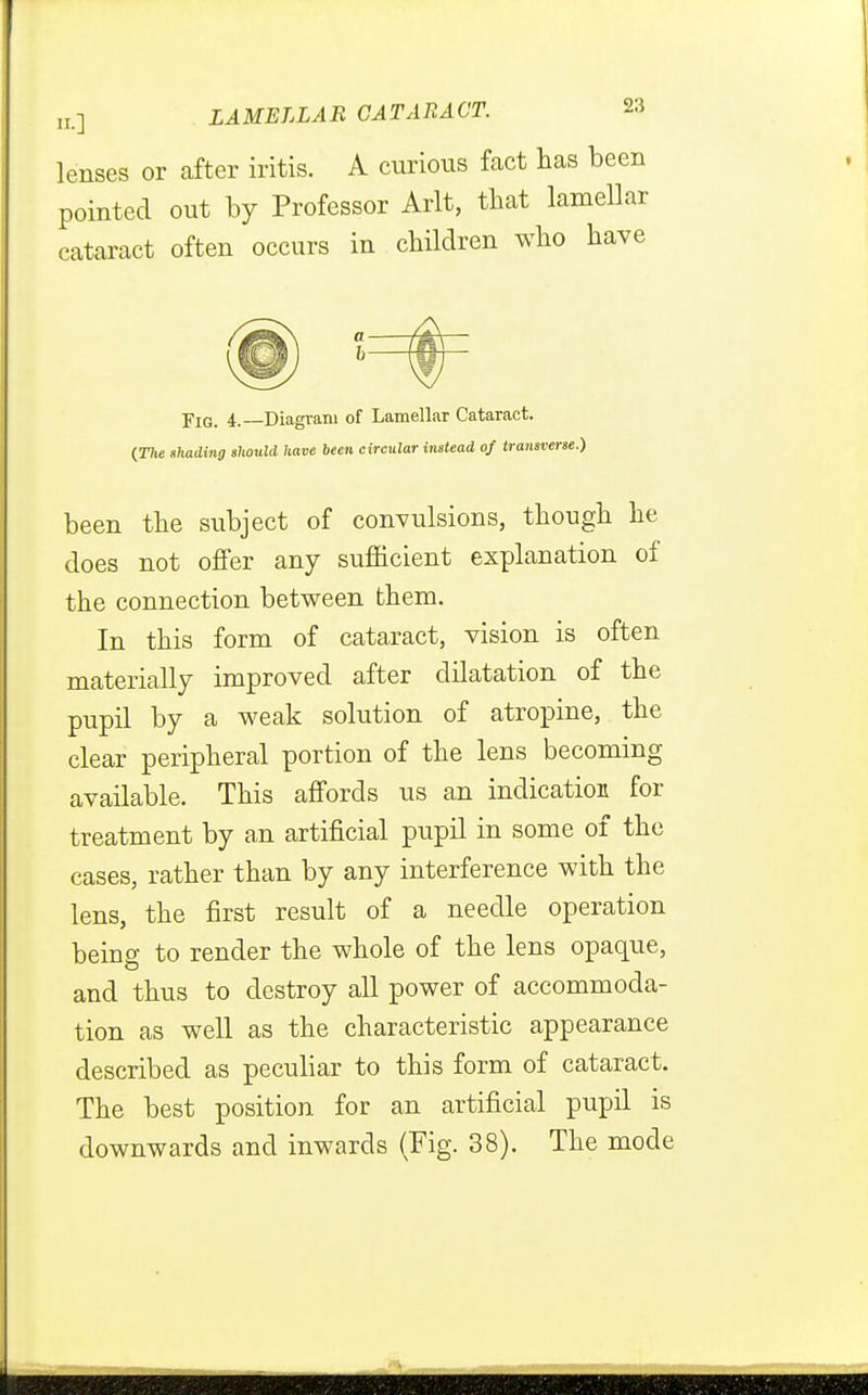 lenses or after iritis. A curious fact has bee: pointed out by Professor Arlt, that lamella cataract often occurs in children who hav ]?iG_ 4. Diagram of Lamellar Cataract. (The shading should have been circular instead of transverse.) been the subject of convulsions, though he does not offer any sufficient explanation of the connection between them. In this form of cataract, vision is often materially improved after dilatation of the pupil by a weak solution of atropine, the clear peripheral portion of the lens becoming available. This affords us an indication for treatment by an artificial pupil in some of the cases, rather than by any interference with the lens, the first result of a needle operation being to render the whole of the lens opaque, and thus to destroy all power of accommoda- tion as well as the characteristic appearance described as peculiar to this form of cataract. The best position for an artificial pupil is downwards and inwards (Fig. 38). The mode