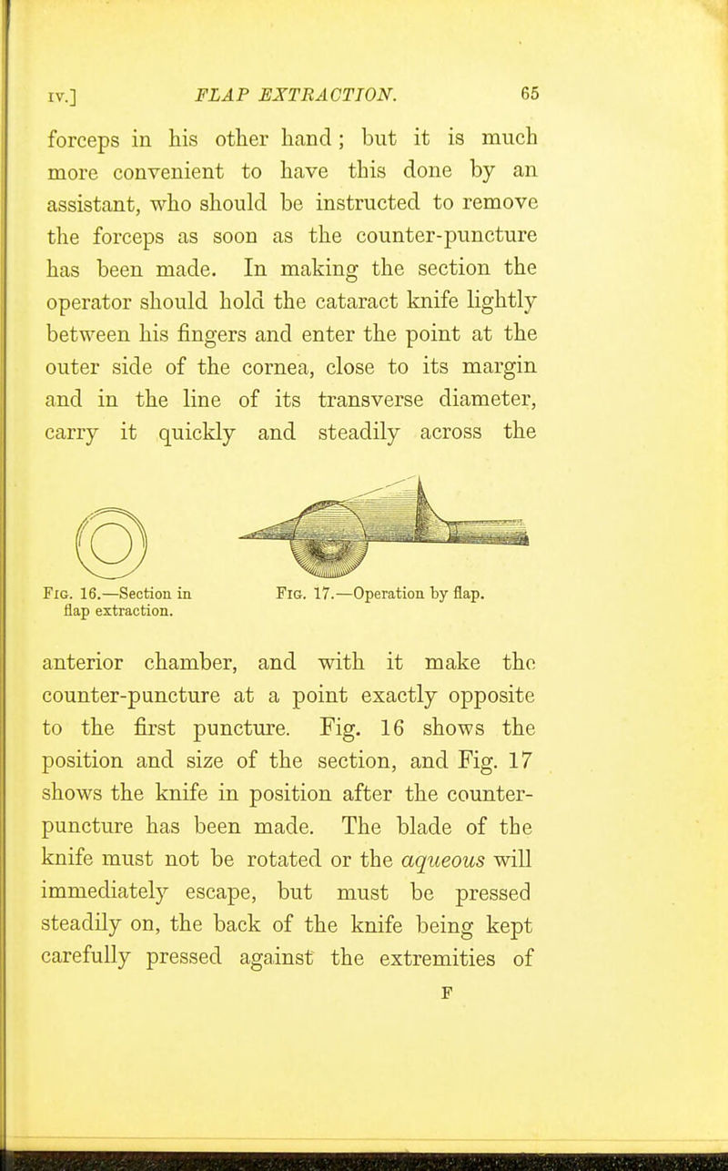 forceps in his other hand; but it is much more convenient to have this done by an assistant, who should be instructed to remove the forceps as soon as the counter-puncture has been made. In making the section the operator should hold the cataract knife lightly- between his fingers and enter the point at the outer side of the cornea, close to its margin and in the line of its transverse diameter, carry it quickly and steadily across the Fig. 16.—Section in Fig. 17.—Operation by flap, flap extraction. anterior chamber, and with it make the counter-puncture at a point exactly opposite to the first puncture. Fig. 16 shows the position and size of the section, and Fig. 17 shows the knife in position after the counter- puncture has been made. The blade of the knife must not be rotated or the aqueous will immediately escape, but must be pressed steadily on, the back of the knife being kept carefully pressed against the extremities of F