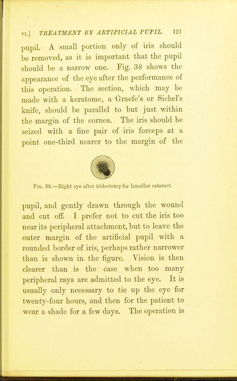 pupil. A small portion only of iris should be removed, as it is important that the pupil should be a narrow one. Fig. 38 shows the appearance of the eye after the performance of this operation. The section, which may be made with a keratome, a Graefe's or Sichel's knife, should be parallel to but just within the margin of the cornea. The iris should be seized with a fine pair of iris forceps at a point one-third nearer to the margin of the (§> Fig. 38.—Eight eye after iridectomy for lamellar cataract. pupil, and gently drawn through the wound and cut off I prefer not to cut the iris too near its peripheral attachment, but to leave the outer margin of the artificial pupil with a rounded border of iris, perhaps rather narrower than is shown in the figure. Vision is then clearer than is the case when too many peripheral rays are admitted to the eye. It is usually only necessary to tie up the eye for twenty-four hours, and then for the patient to wear a shade for a few days. The operation is