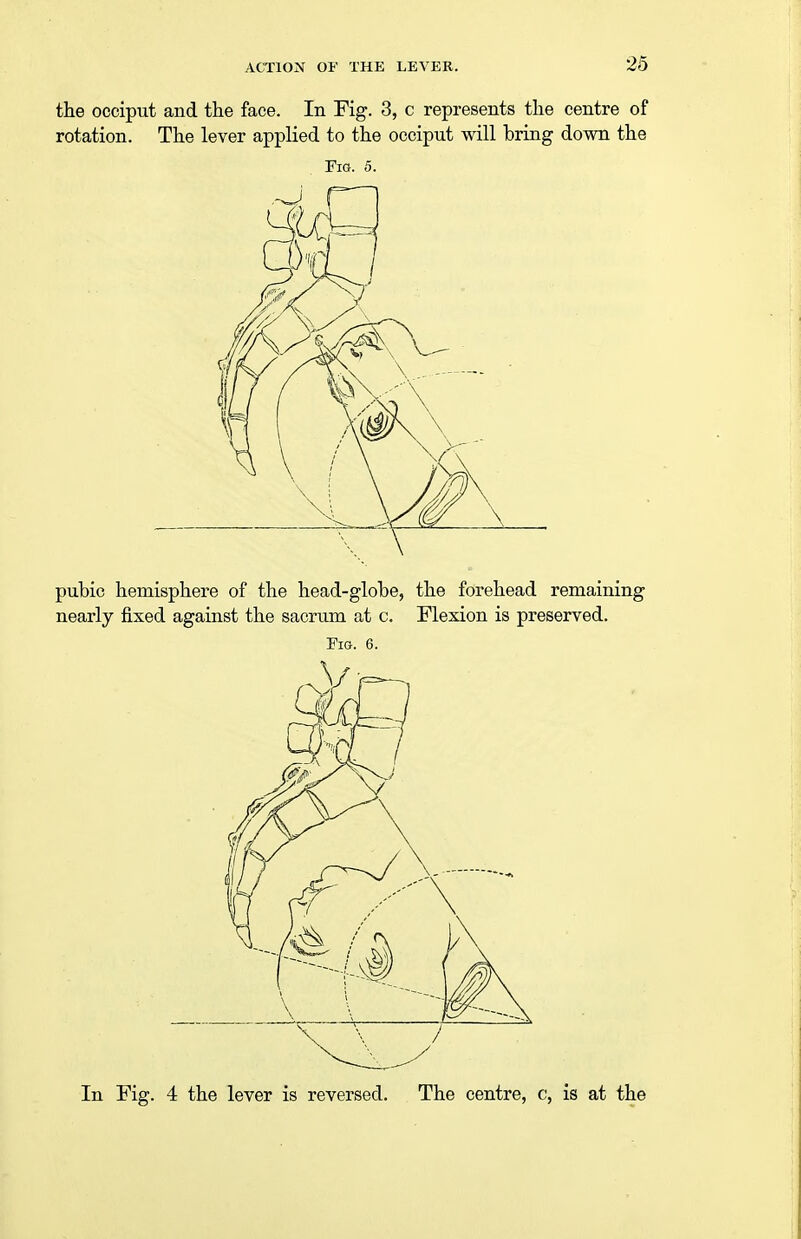 the occiput and the face. In Fig. 3, c represents the centre of rotation. The lever applied to the occiput will bring down the Fig. 5. pubic hemisphere of the head-globe, the forehead remaining nearly fixed against the sacrum at c. Flexion is preserved. Fig. 6. In Fig. 4 the lever is reversed. The centre, c, is at the