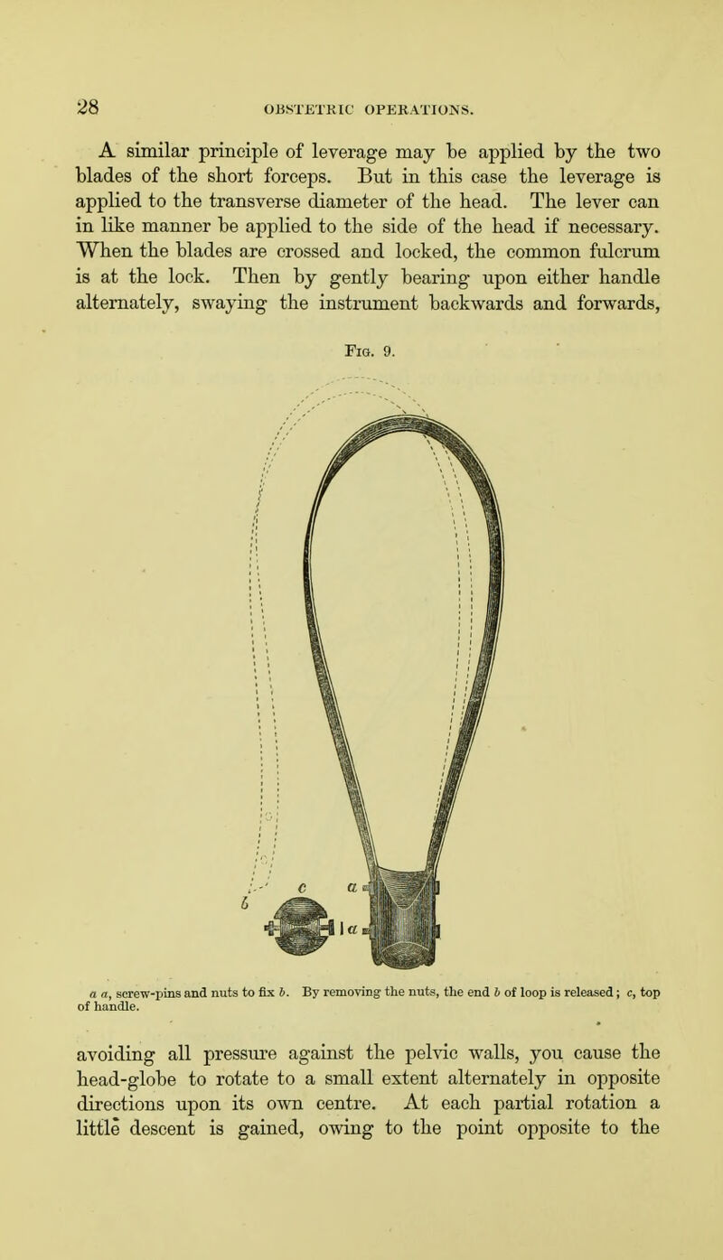 A similar principle of leverage may be applied by the two blades of the short forceps. But in this case the leverage is applied to the transverse diameter of the head. The lever can in like manner be applied to the side of the head if necessary. When the blades are crossed and locked, the common fulcrum is at the lock. Then by gently bearing upon either handle alternately, swaying the instrument backwards and forwards, Fig. 9. a a, screw-pins and nuts to fix b. By removing the nuts, the end b of loop is released; c, top of handle. avoiding all pressure against the pelvic walls, you cause the head-globe to rotate to a small extent alternately in opposite directions upon its own centre. At each partial rotation a little descent is gained, owing to the point opposite to the