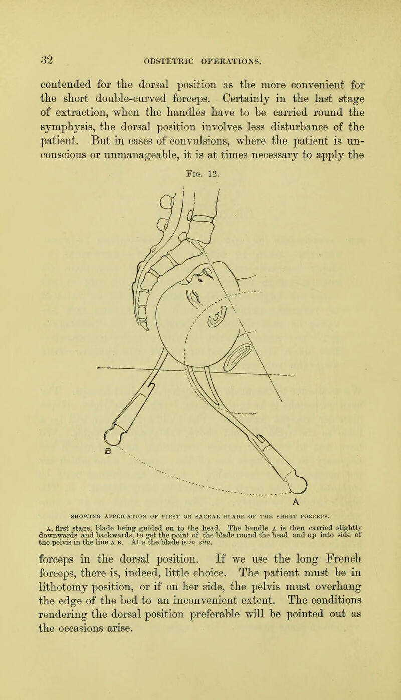 contended for the dorsal position as the more convenient for the short double-curved forceps. Certainly in the last stage of extraction, when the handles have to be carried round the symphysis, the dorsal position involves less disturbance of the patient. But in cases of convulsions, where the patient is un- conscious or unmanageable, it is at times necessary to apply the Fig. 12. SHOWING APPLICATION OF FIRST OP. SACRAL BLADE OF THE SHOUT FORCEPS. A, first stage, blade being guided on to the head. The handle A is then carried slightly downwards and backwards, to get the point of the blade round the head and up into side of the pelvis in the line A B. At b the blade is in situ. forceps in the dorsal position. If we use the long French forceps, there is, indeed, little choice. The patient must be in lithotomy position, or if on her side, the pelvis must overhang the edge of the bed to an inconvenient extent. The conditions rendering the dorsal position preferable will be pointed out as the occasions arise.