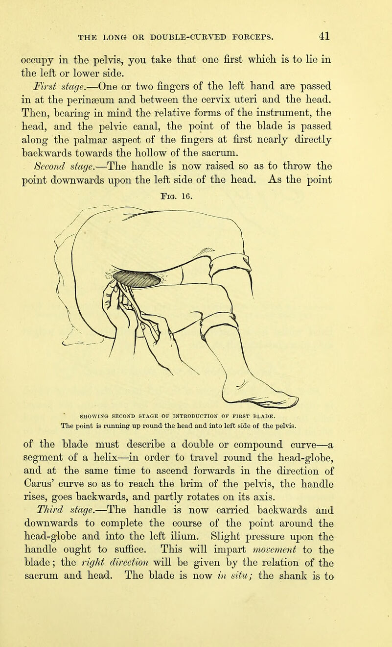 occupy in the pelvis, you take that one first which is to lie in the left or lower side. First stage.—One or two fingers of the left hand are passed in at the perinaBum and between the cervix uteri and the head. Then, bearing in mind the relative forms of the instrument, the head, and the pelvic canal, the point of the blade is passed along the palmar aspect of the fingers at first nearly directly backwards towards the hollow of the sacrum. Second stage.—The handle is now raised so as to throw the point downwards upon the left side of the head. As the point Fig. 16. SHOWING SECOND STAGE OF INTRODUCTION OF FIRST BLADE. The point is running up round the head and into left side of the pelvis. of the blade must describe a double or compound curve—a segment of a helix—in order to travel round the head-globe, and at the same time to ascend forwards in the direction of Cams' curve so as to reach the brim of the pelvis, the handle rises, goes backwards, and partly rotates on its axis. Third stage.—The handle is now carried backwards and downwards to complete the course of the point around the head-globe and into the left ilium. Slight pressure upon the handle ought to suffice. This will impart movement to the blade; the right direction will be given by the relation of the sacrum and head. The blade is now in situ; the shank is to