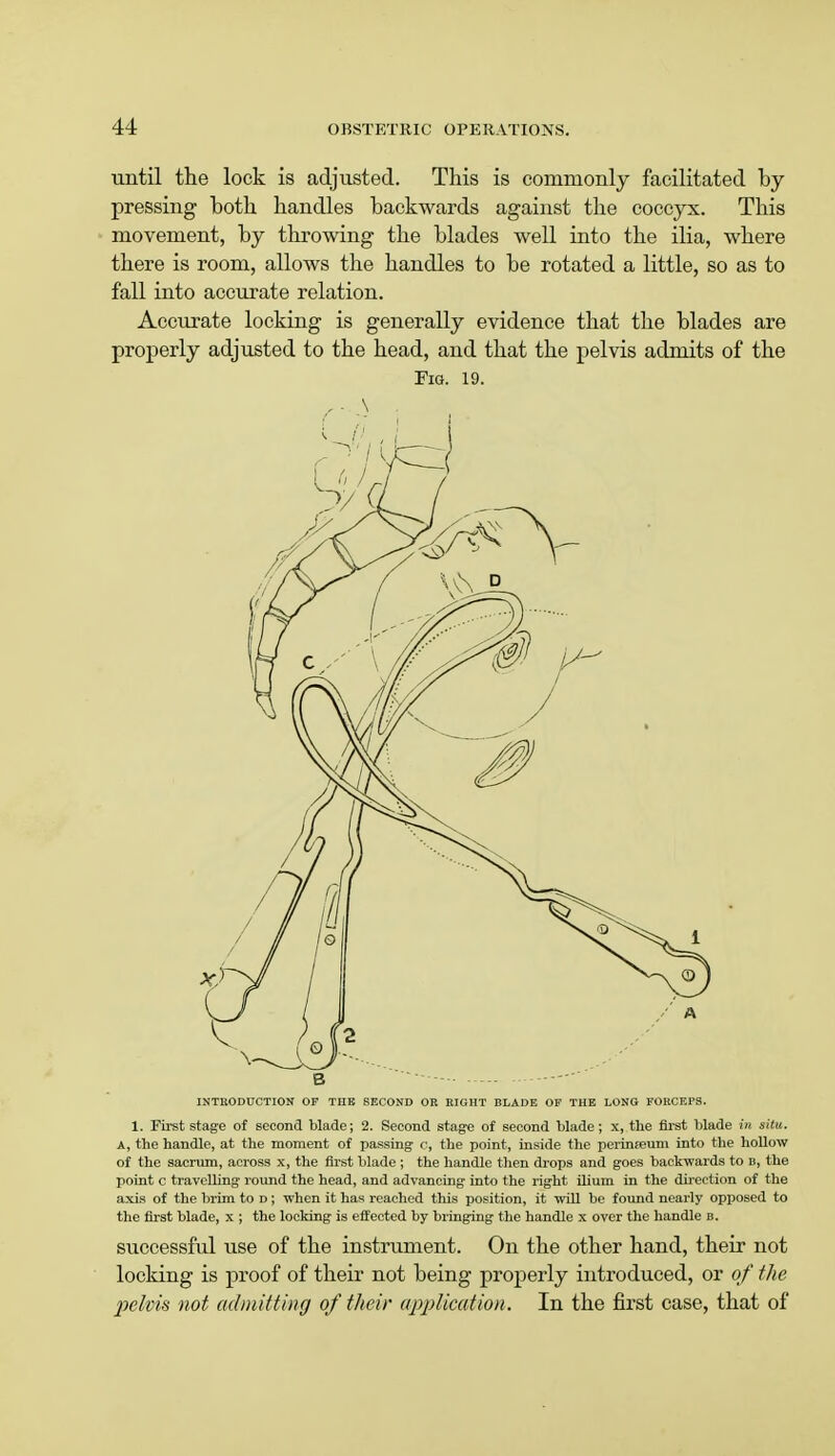 until the lock is adjusted. This is commonly facilitated by pressing hoth handles backwards against the coccyx. This movement, by throwing the blades well into the ilia, where there is room, allows the handles to be rotated a little, so as to fall into accurate relation. Accurate locking is generally evidence that the blades are properly adjusted to the head, and that the pelvis admits of the Fig. 19. \ 3 INTRODUCTION OF THE SECOND OR RIGHT BLADE OF THE LONG FOKCEPS. 1. First stage of second blade; 2. Second stage of second blade ; x, the first blade in situ. A, the handle, at the moment of passing c, the point, inside the perinfeum into the hollow of the sacrum, across x, the first blade ; the handle then drops and goes backwards to b, the point c travelling round the head, and advancing into the right ilium in the direction of the axis of the brim to d ; when it has reached this position, it will be found nearly opposed to the first blade, x ; the locking is effected by bringing the handle x over the handle b. successful use of the instrument. On the other hand, their not locking is proof of their not being properly introduced, or of the pelvis not admitting of their application. In the first case, that of