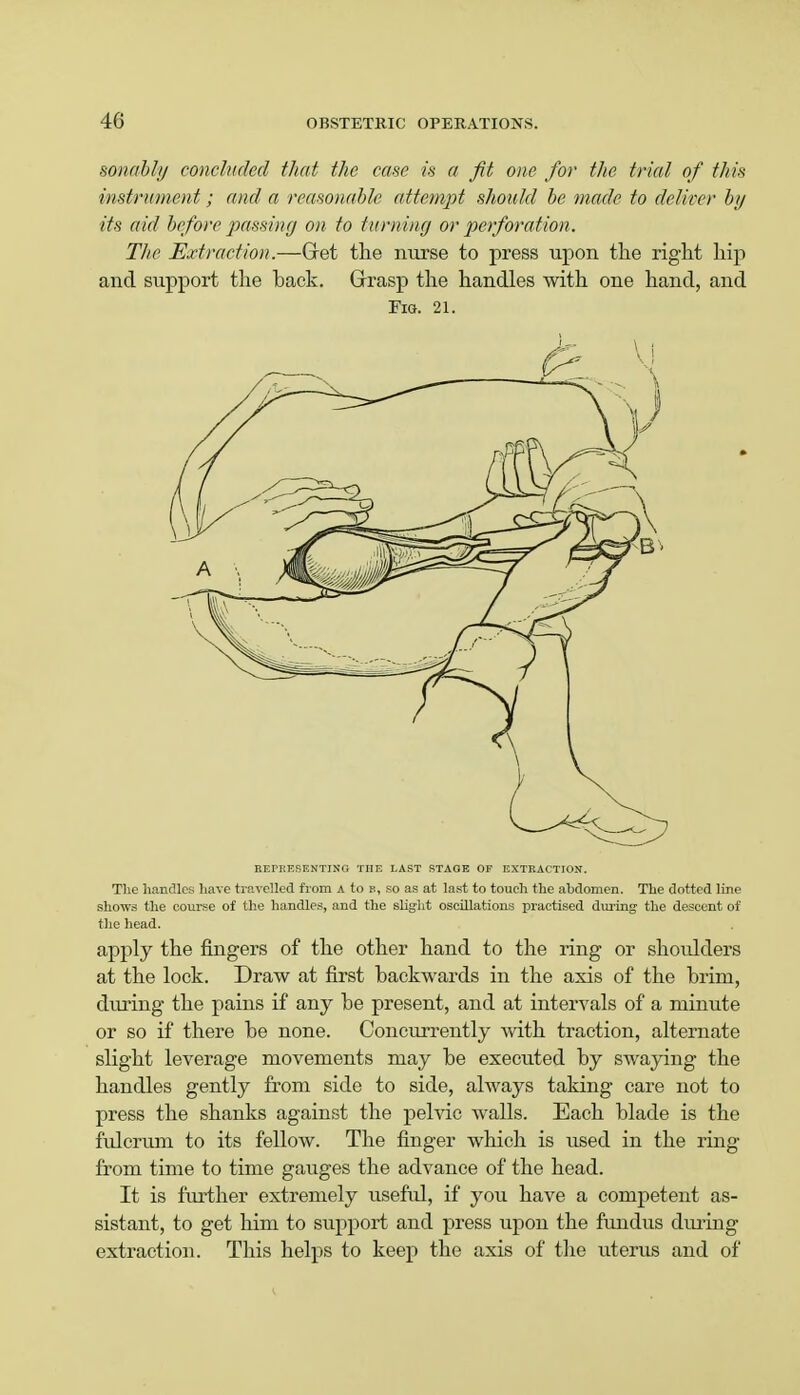 sonahlg concluded that the case is a fit one for the trial of this instrument; and a reasonable attempt should be made to deliver by its aid before passing on to turning or perforation. The Extraction.—Gret the nurse to press upon the right hip and support the hack. Grasp the handles with one hand, and Fig. 21. BBPBESENTINQ THE LAST STAOE OF EXTRACTION. The handles have travelled from A to b, so as at last to touch the abdomen. The dotted line shows the course of the handles, and the slight oscillations practised during the descent of the head. apply the fingers of the other hand to the ring or shoulders at the lock. Draw at first backwards in the axis of the brim, during the pains if any be present, and at intervals of a minute or so if there be none. Concurrently with traction, alternate slight leverage movements may be executed by swaying the handles gently from side to side, always taking care not to press the shanks against the pelvic walls. Each blade is the fulcrum to its fellow. The finger which is used in the ring from time to time gauges the advance of the head. It is further extremely useful, if you have a competent as- sistant, to get him to support and press upon the fundus during extraction. This helps to keep the axis of the uterus and of