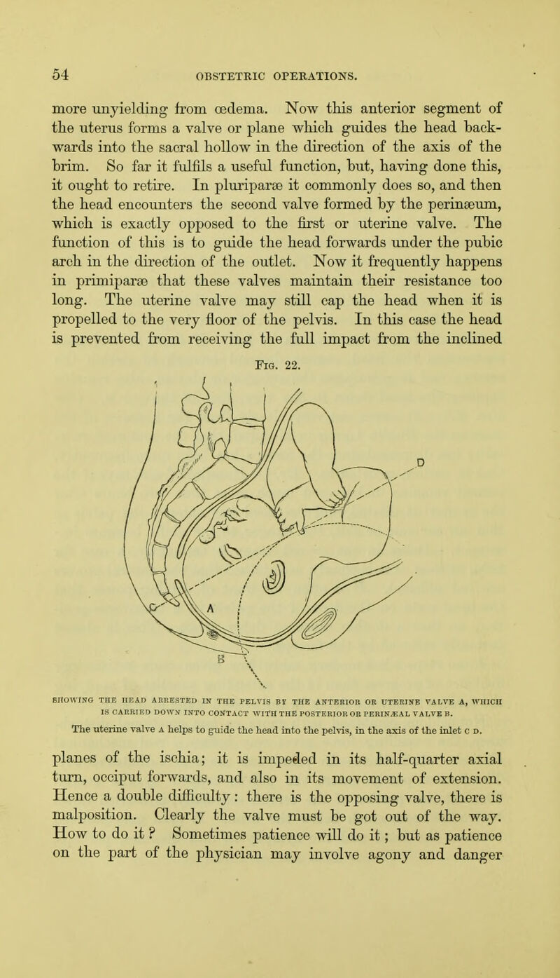 more unyielding from oedema. Now this anterior segment of the uterus forms a valve or plane which guides the head back- wards into the sacral hollow in the direction of the axis of the brim. So far it fulfils a useful function, but, having done this, it ought to retire. In pluriparae it commonly does so, and then the head encounters the second valve formed by the perinaeum, which is exactly opposed to the first or uterine valve. The function of this is to guide the head forwards under the pubic arch in the direction of the outlet. Now it frequently happens in primiparee that these valves maintain their resistance too long. The uterine valve may still cap the head when it is propelled to the very floor of the pelvis. In this case the head is prevented from receiving the full impact from the inclined Fig. 22. SnOHINO THE HEAD ARRESTED IN TIIE PELVIS BI THE ANTERIOR OR UTERINE VALVE A, WHICH IS CARRIED DOWN INTO CONTACT WITH THE POSTERIOROR PERINEAL VALVE P.. The uterine valve a helps to guide the head into the pelvis, in the axis of the inlet c d. planes of the ischia; it is impeded in its half-quarter axial turn, occiput forwards, and also in its movement of extension. Hence a double difficulty : there is the opposing valve, there is malposition. Clearly the valve must be got out of the way. How to do it ? Sometimes patience will do it; but as patience on the part of the physician may involve agony and danger