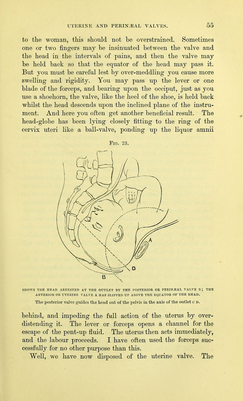 to the woman, this should not he overstrained. Sometimes one or two fingers may he insinuated between the valve and the head in the intervals of pains, and then the valve may he held hack so that the equator of the head may pass it. But you must he careful lest by over-meddling you cause more swelling and rigidity. You may pass up the lever or one blade of the forceps, and bearing upon the occiput, just as you use a shoehorn, the valve, like the heel of the shoe, is held back whilst the head descends upon the inclined plane of the instru- ment. And here you often get another beneficial result. The head-globe has been lying closely fitting to the ring of the cervix uteri like a ball-valve, ponding up the liquor amnii Fig. 23. SHOWS THE HEAD ARRESTED AT THE OUTLET BY THE POSTERIOR OR PERINEAL VALVE B ; THE ANTERIOR OR UTERINE VALVE A HAS SLIPPED UP ABOVE THE EQUATOR OF THE HEAD. The posterior valve guides the head out of the pelvis in the axis of the outlet c d. behind, and impeding the full action of the uterus by over- distending it. The lever or forceps opens a channel for the escape of the pent-up fluid. The uterus then acts immediately, and the labour proceeds. I have often used the forceps suc- cessfully for no other purpose than this. Well, we have now disposed of the uterine valve. The