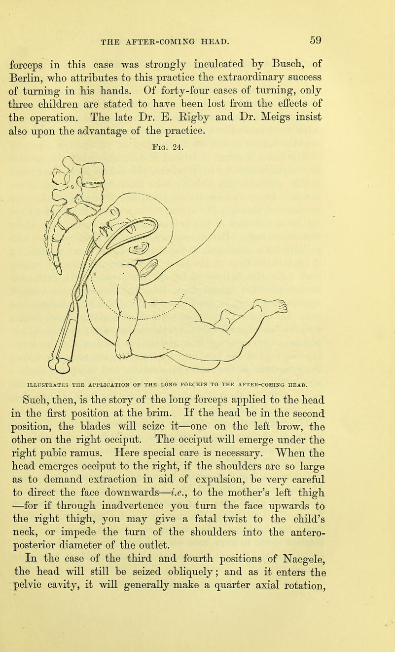 forceps in this case was strongly inculcated by Busch, of Berlin, who attributes to this practice the extraordinary success of turning in his hands. Of forty-four cases of turning, only three children are stated to have been lost from the effects of the operation. The late Dr. E. Bigby and Dr. Meigs insist also upon the advantage of the practice. Fig. 24. ILLUSTRATES THE APPLICATION OF THE LONG FOP.CEPS TO THE AFTER-COMING HEAD. Such, then, is the story of the long forceps applied to the head in the first position at the brim. If the head be in the second position, the blades will seize it—one on the left brow, the other on the right occiput. The occiput will emerge under the right pubic ramus. Here special care is necessary. When the head emerges occiput to the right, if the shoulders are so large as to demand extraction in aid of expulsion, be very careful to direct the face downwards—i.e., to the mother's left thigh —for if through inadvertence you turn the face upwards to the right thigh, you may give a fatal twist to the child's neck, or impede the turn of the shoulders into the antero- posterior diameter of the outlet. In the case of the third and fourth positions of Naegele, the head will still be seized obliquely; and as it enters the pelvic cavity, it will generally make a quarter axial rotation,
