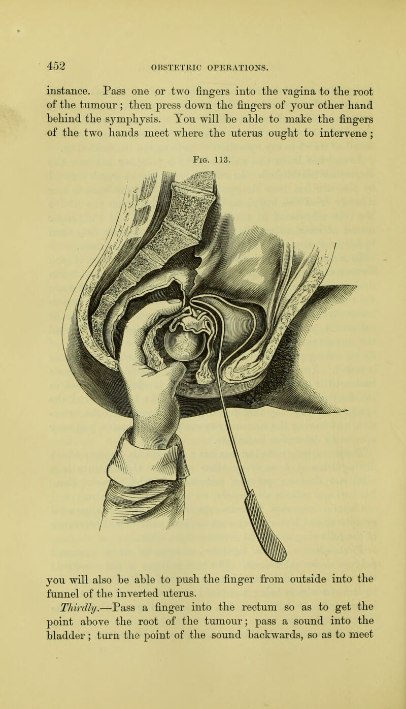 instance. Pass one or two fingers into the vagina to the root of the tumour ; then press down the fingers of your other hand behind the symphysis. You will be able to make the fingers of the two hands meet where the uterus ought to intervene ; Fig. 113. you will also be able to push the finger from outside into the funnel of the inverted uterus. Thirdly.—Pass a finger into the rectum so as to get the point above the root of the tumour; pass a sound into the bladder ; turn the point of the sound backwards, so as to meet