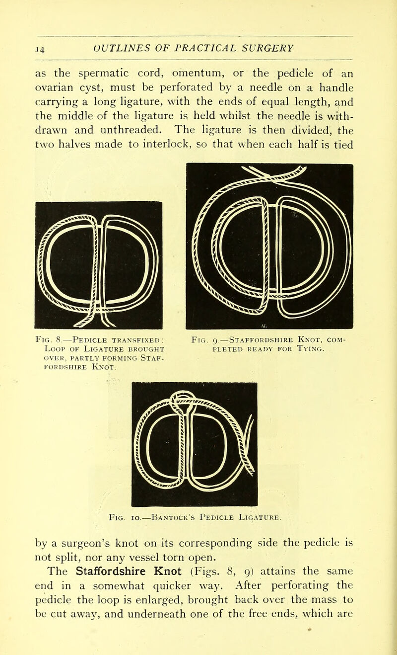 as the spermatic cord, omentum, or the pedicle of an ovarian cyst, must be perforated by a needle on a handle carrying a long ligature, with the ends of equal length, and the middle of the ligature is held whilst the needle is with- drawn and unthreaded. The ligature is then divided, the two halves made to interlock, so that when each half is tied Fig. 8.—Pedicle transfixed: Fig. 9.—Staffordshire Knot, com- Loop of Ligature brought pleted ready for Tying, over, partly forming Staf- fordshire Knot. Fig. 10.—Bantock's Pedicle Ligature. by a surgeon's knot on its corresponding side the pedicle is not split, nor any vessel torn open. The Staffordshire Knot (Figs. 8, 9) attains the same end in a somewhat quicker way. After perforating the pedicle the loop is enlarged, brought back over the mass to be cut away, and underneath one of the free ends, which are