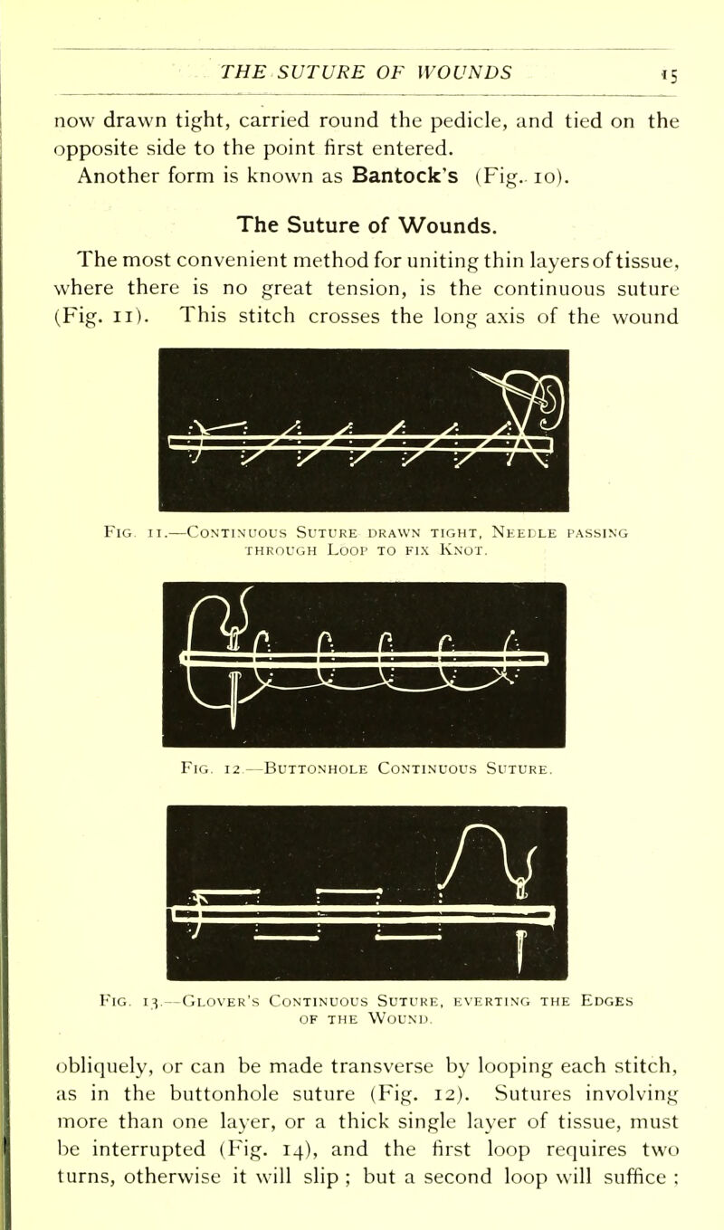 now drawn tight, carried round the pedicle, and tied on the opposite side to the point first entered. Another form is known as Bantock's (Fig. 10). The Suture of Wounds. The most convenient method for uniting thin layers of tissue, where there is no great tension, is the continuous suture (Fig. 11). This stitch crosses the long axis of the wound Fig. 11.—Continuous Suture drawn tight, Needle passing through Loop to fix Knot. Fig. 12 —Buttonhole Continuous Suture. Fig. 13.—Glover's Continuous Suture, everting the Edges of the Wound. obliquely, or can be made transverse by looping each stitch, as in the buttonhole suture (Fig. 12). Sutures involving more than one layer, or a thick single layer of tissue, must be interrupted (Fig. 14), and the first loop requires two turns, otherwise it will slip ; but a second loop will suffice ;