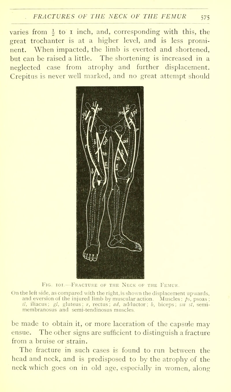 varies from § to 1 inch, and, corresponding with this, the great trochanter is at a higher level, and is less promi- nent. When impacted, the limb is everted and shortened, but can be raised a little. The shortening is increased in a neglected case from atrophy and further displacement. Crepitus is never well marked, and no great attempt should Fig. ioi.—Fracture of the Neck of the Femur. On the left side, as compared with the right, is shown the displacement upwards, and eversion of the injured limb by muscular action. Muscles : ps, psoas ; il, iliacus; gt, gluteus ; r, rectus ; ad, adductor ; b, biceps ; sm it, semi- membranosus and semi-tendinosus muscles. be made to obtain it, or more laceration of the capsule may ensue. The other signs are sufficient to distinguish a fracture from a bruise or strain. The fracture in such cases is found to run between the head and neck, and is predisposed to by the atrophy of the neck which goes on in old age, especially in women, along