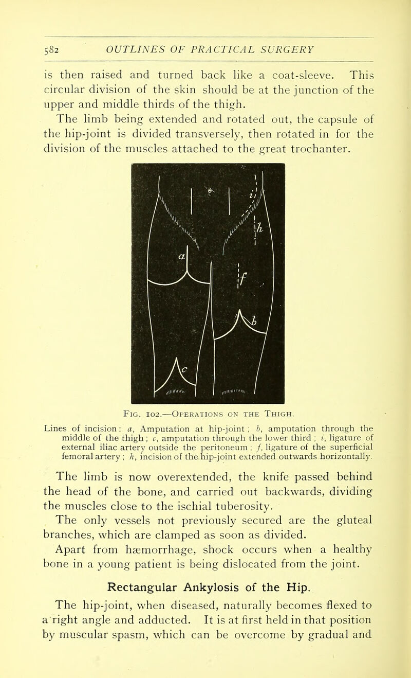 is then raised and turned back like a coat-sleeve. This circular division of the skin should be at the junction of the upper and middle thirds of the thigh. The limb being extended and rotated out, the capsule of the hip-joint is divided transversely, then rotated in for the division of the muscles attached to the great trochanter. Fig. 102.—Operations on the Thjgh. Lines of incision: a, Amputation at hip-joint ; b, amputation through the middle of the thigh; c, amputation through the lower third ; i, ligature of external iliac artery outside the peritoneum ; /, ligature of the superficial femoral artery ; /;, incision of the hip-joint extended outwards horizontally. The limb is now overextended, the knife passed behind the head of the bone, and carried out backwards, dividing the muscles close to the ischial tuberosity. The only vessels not previously secured are the gluteal branches, which are clamped as soon as divided. Apart from haemorrhage, shock occurs when a healthy bone in a young patient is being dislocated from the joint. Rectangular Ankylosis of the Hip. The hip-joint, when diseased, naturally becomes flexed to a right angle and adducted. It is at first held in that position by muscular spasm, which can be overcome by gradual and