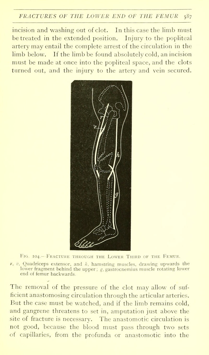 incision and washing out of clot. In this case the limb must be treated in the extended position. Injury to the popliteal artery may entail the complete arrest of the circulation in the limb below. If the limb be found absolutely cold, an incision must be made at once into the popliteal space, and the clots turned out, and the injury to the artery and vein secured. Fig. 104.— Fracture through the Lower Third of the Femur. V, v, Quadriceps extensor, and /;, hamstring muscles, drawing upwards the lower fragment behind the upper ; g, gastrocnemius muscle rotating lower end of femur backwards. The removal of the pressure of the clot may allow of suf- ficient anastomosing circulation through the articular arteries. But the case must be watched, and if the limb remains cold, and gangrene threatens to set in, amputation just above the site of fracture is necessary. The anastomotic circulation is not good, because the blood must pass through two sets of capillaries, from the profunda or anastomotic into the