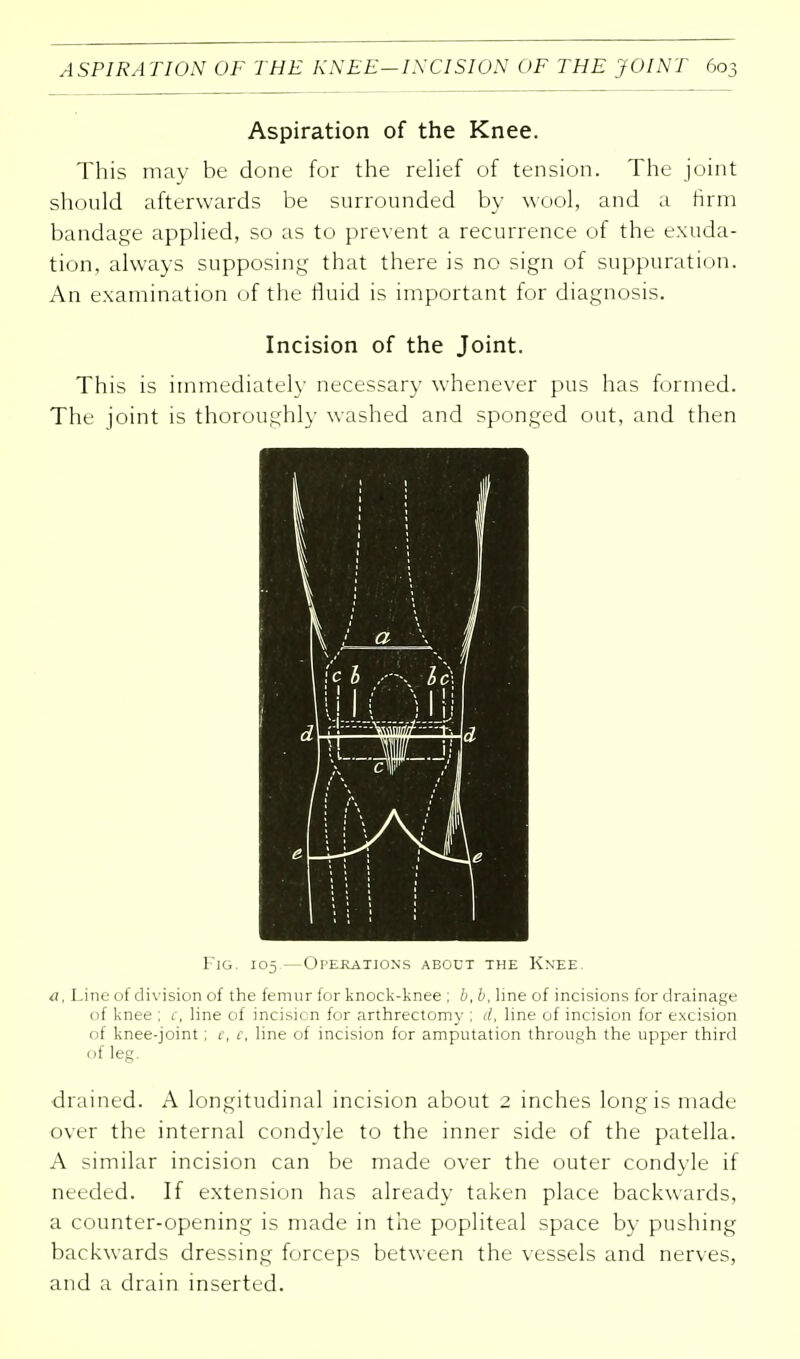 Aspiration of the Knee. This may be done for the relief of tension. The joint should afterwards be surrounded by wool, and a firm bandage applied, so as to prevent a recurrence of the exuda- tion, always supposing that there is no sign of suppuration. An examination of the fluid is important for diagnosis. Incision of the Joint. This is immediately necessary whenever pus has formed. The joint is thoroughly washed and sponged out, and then Fig. 105 —Opekations about the Knee. a, Line of division of the femur for knock-knee ; b, b, line of incisions for drainage of knee ; c, line of incision for arthrectomy ; d, line of incision for excision of knee-joint; c, c, line of incision for amputation through the upper third of leg. drained. A longitudinal incision about 2 inches long is made over the internal condyle to the inner side of the patella. A similar incision can be made over the outer condyle if needed. If extension has already taken place backwards, a counter-opening is made in the popliteal space by pushing backwards dressing forceps between the vessels and nerves, and a drain inserted.
