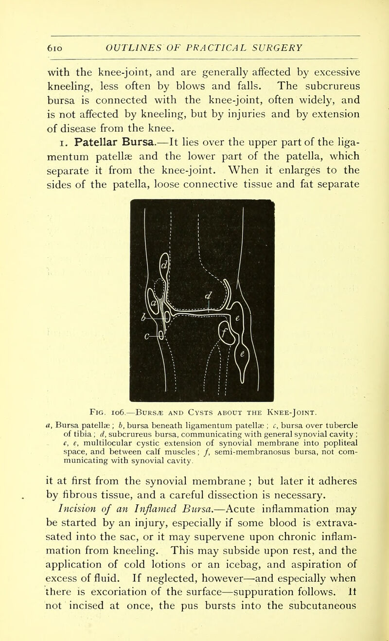 with the knee-joint, and are generally affected by excessive kneeling, less often by blows and falls. The subcrureus bursa is connected with the knee-joint, often widely, and is not affected by kneeling, but by injuries and by extension of disease from the knee. i. Patellar Bursa.—It lies over the upper part of the liga- mentum patellae and the lower part of the patella, which separate it from the knee-joint. When it enlarges to the sides of the patella, loose connective tissue and fat separate Fig. 106.—Burs^e and Cysts about the Knee-Joint. a, Bursa patellae ; b, bursa beneath ligamentum patellae ; c, bursa over tubercle of tibia ; d, subcrureus bursa, communicating with general synovial cavity ; e, e, multilocular cystic extension of synovial membrane into popliteal space, and between calf muscles ; /, semi-membranosus bursa, not com- municating with synovial cavity. it at first from the synovial membrane ; but later it adheres by fibrous tissue, and a careful dissection is necessary. Incision of an Inflamed Bursa.—Acute inflammation may be started by an injury, especially if some blood is extrava- sated into the sac, or it may supervene upon chronic inflam- mation from kneeling. This may subside upon rest, and the application of cold lotions or an icebag, and aspiration of excess of fluid. If neglected, however—and especially when there is excoriation of the surface—suppuration follows. 11 not incised at once, the pus bursts into the subcutaneous