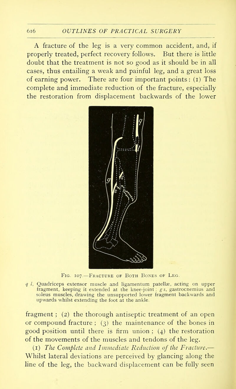 A fracture of the leg is a very common accident, and, if properly treated, perfect recovery follows. But there is little doubt that the treatment is not so good as it should be in all cases, thus entailing a weak and painful leg, and a great loss of earning power. There are four important points : (i) The complete and immediate reduction of the fracture, especially the restoration from displacement backwards of the lower q I, Quadriceps extensor muscle and ligamentum patella?, acting on upper fragment, keeping it extended at the knee-joint; gs, gastrocnemius and soleus muscles, drawing the unsupported lower fragment backwards and upwards whilst extending the foot at the ankle. fragment ; (2) the thorough antiseptic treatment of an open or compound fracture ; (3) the maintenance of the bones in good position until there is firm union ; (4) the restoration of the movements of the muscles and tendons of the leg. (1) The Complete and Immediate Reduction of the Fracture.— Whilst lateral deviations are perceived by glancing along the line of the leg, the backward displacement can be fully seen Fig. 107.—Fracture of Both Bones of Leg.