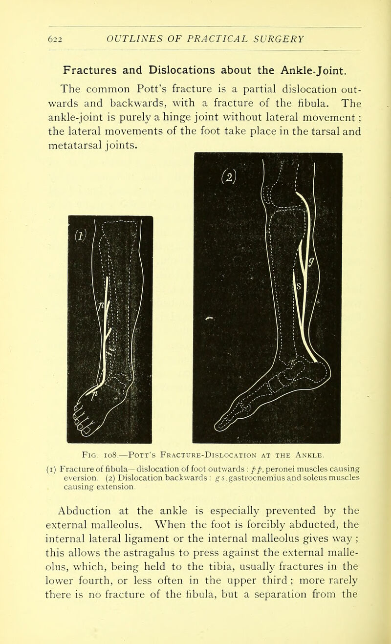 Fractures and Dislocations about the Ankle-Joint. The common Pott's fracture is a partial dislocation out- wards and backwards, with a fracture of the fibula. The ankle-joint is purely a hinge joint without lateral movement; the lateral movements of the foot take place in the tarsal and metatarsal joints. Fig. 108.—Pott's Fracture-Dislocation at the Ankle. (i) Fracture of fibula—dislocation of foot outwards : pp, peronei muscles causing eversion. (2) Dislocation backwards : gs, gastrocnemius and soleus muscles causing extension. Abduction at the ankle is especially prevented by the external malleolus. When the foot is forcibly abducted, the internal lateral ligament or the internal malleolus gives way; this allows the astragalus to press against the external malle- olus, which, being held to the tibia, usually fractures in the lower fourth, or less often in the upper third ; more rarely there is no fracture of the fibula, but a separation from the