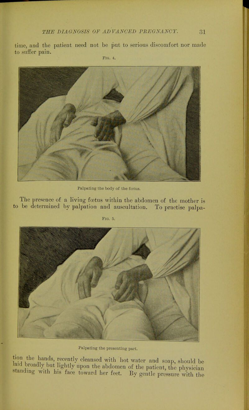 time, and the patient need not be put to serious discomfort nor made to suffer pain. Fig. 4. Palpating the body of the foetus. The presence of a living foetus within the abdomen of the mother is to be determined by palpation and auscultation. To practise palpa- FlG. 5. Palpating the presenting part. tion the hands, recently cleansed with hot water and soap, should be laid broadly but lightly upon the abdomen of the patient, the physician standmg with his face toward her feet. By gentle pressure with the