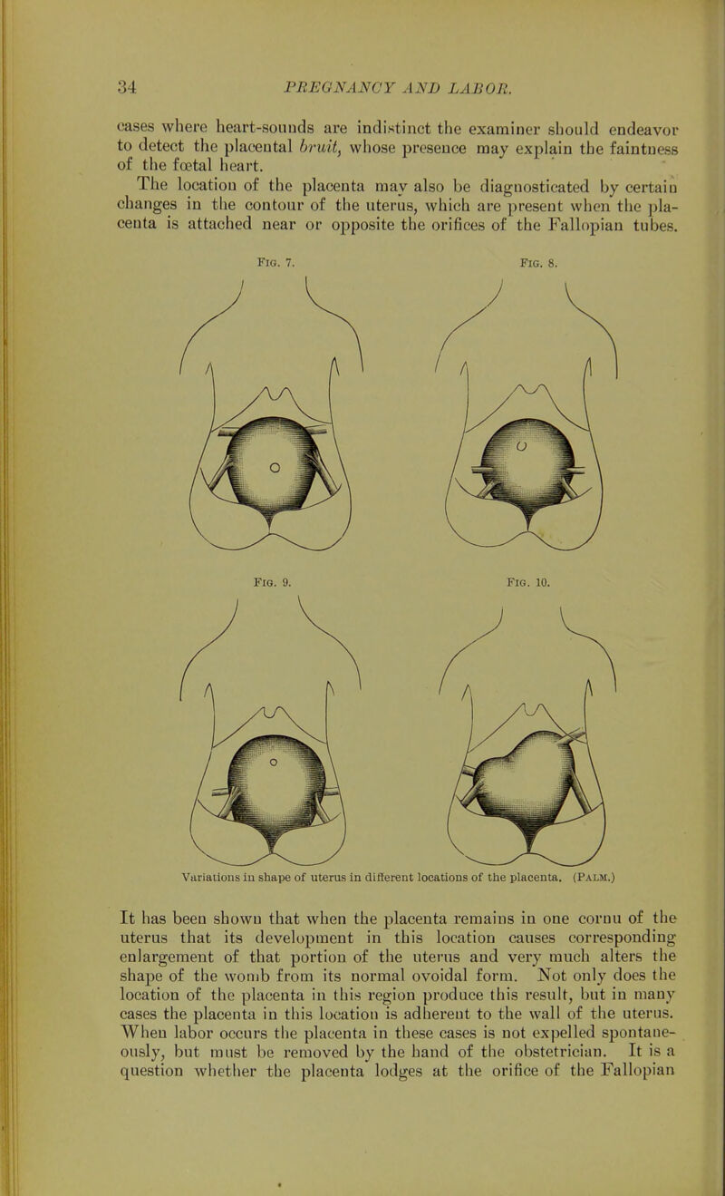 cases where heart-sounds are indistinct the examiner should endeavor to detect the placental bruit, whose presence may explain the faintness of the foetal heart. The location of the placenta may also be diagnosticated by certain changes in the contour of the uterus, which are present when the pla- centa is attached near or opposite the orifices of the Fallopian tubes. Fig. 7. Fig. 8. Variaiious in shape of uterus In difterent locations of the placenta. (Palm.) It has been shown that when the placenta remains in one cornu of the uterus that its development in this location causes corresponding enlargement of that portion of the uterus and very much alters the shape of the womb from its normal ovoidal form. Not only does the location of the placenta in this region produce this result, but in many cases the placenta in this location is adherent to the wall of the uterus. When labor occurs the placenta in these cases is not expelled spontane- ously, but must be removed by the hand of the obstetrician. It is a question whether the placenta lodges at the orifice of the Fallopian